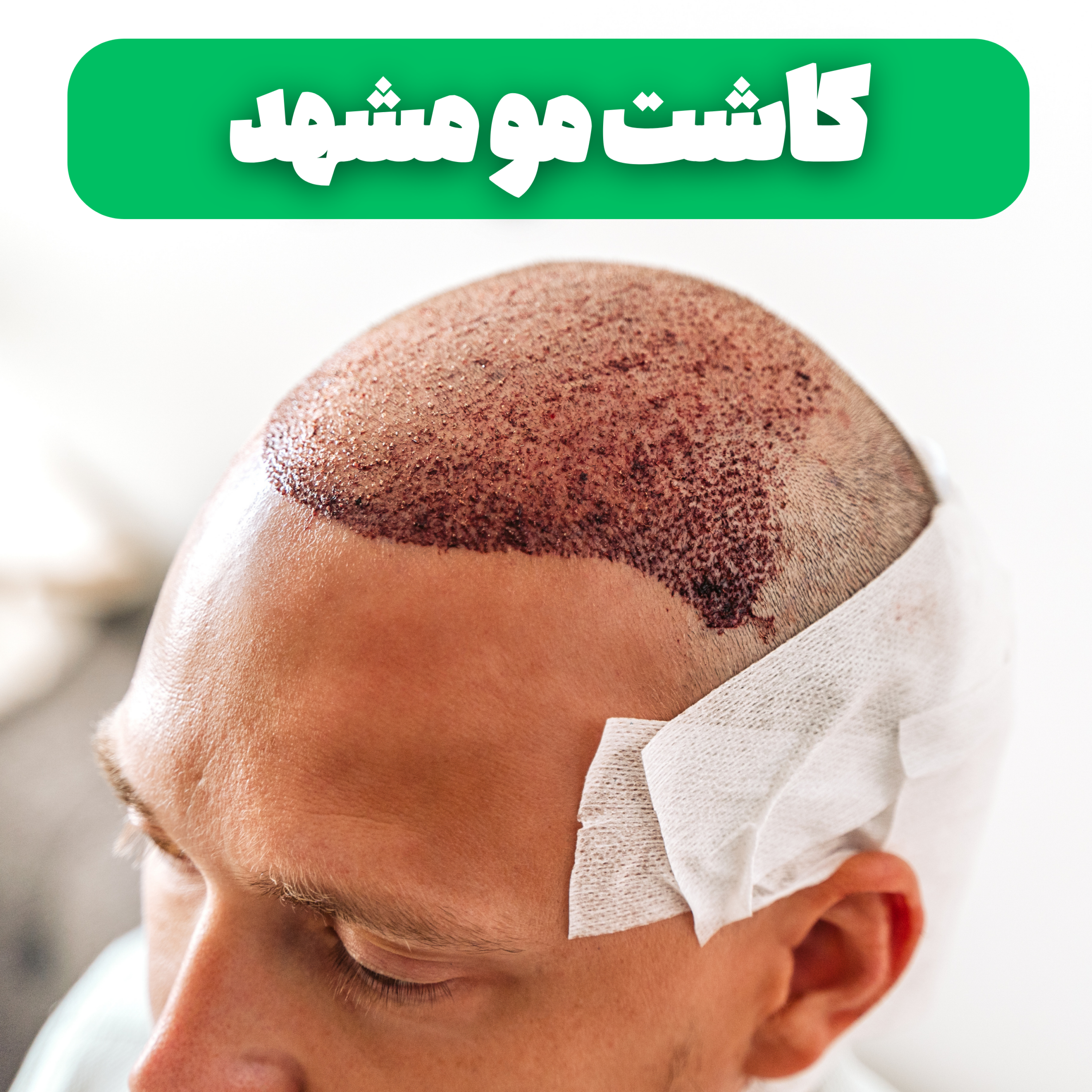 کاور پادکست کاشت مو در مشهد