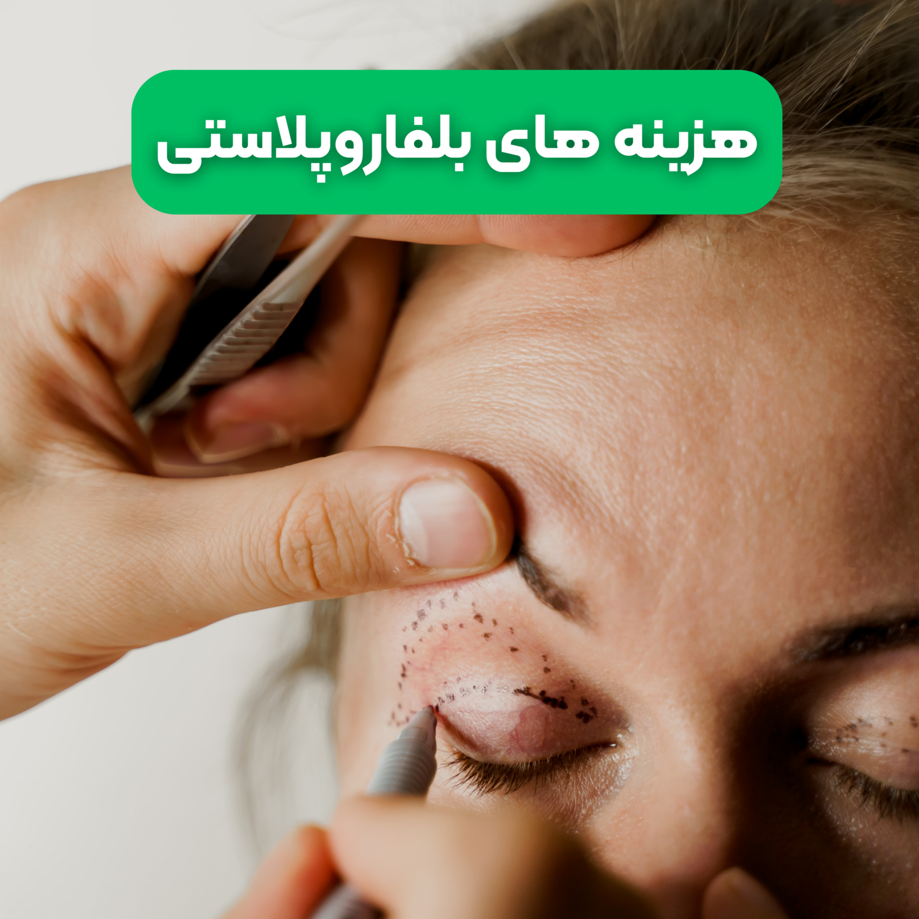 کاور هزینه های بلفاروپلاستی در نوین ایرانا