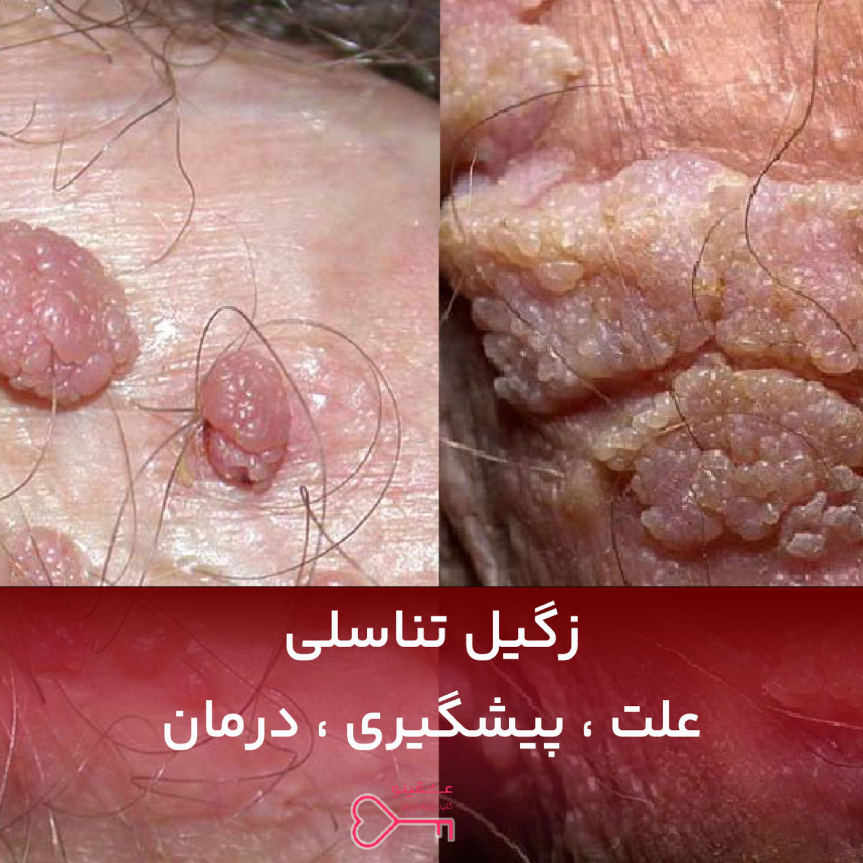 کاور زگیل تناسلی چیست؟ علائم، درمان و پیشگیری