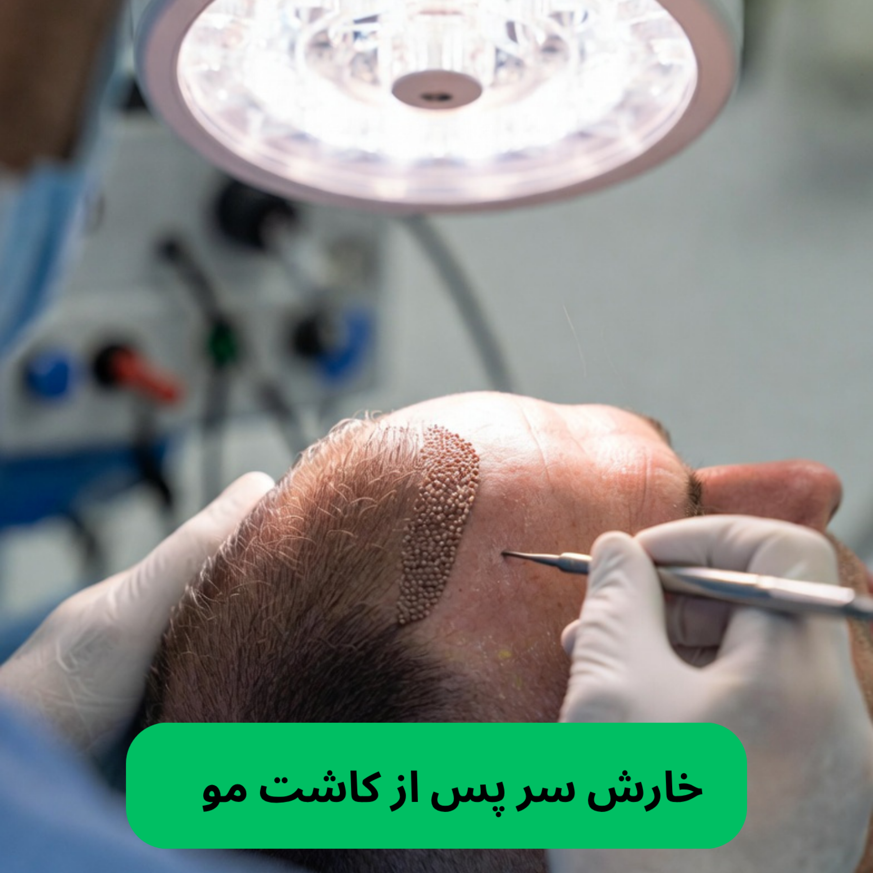 کاور درمان خارش سر پس از کاشت مو