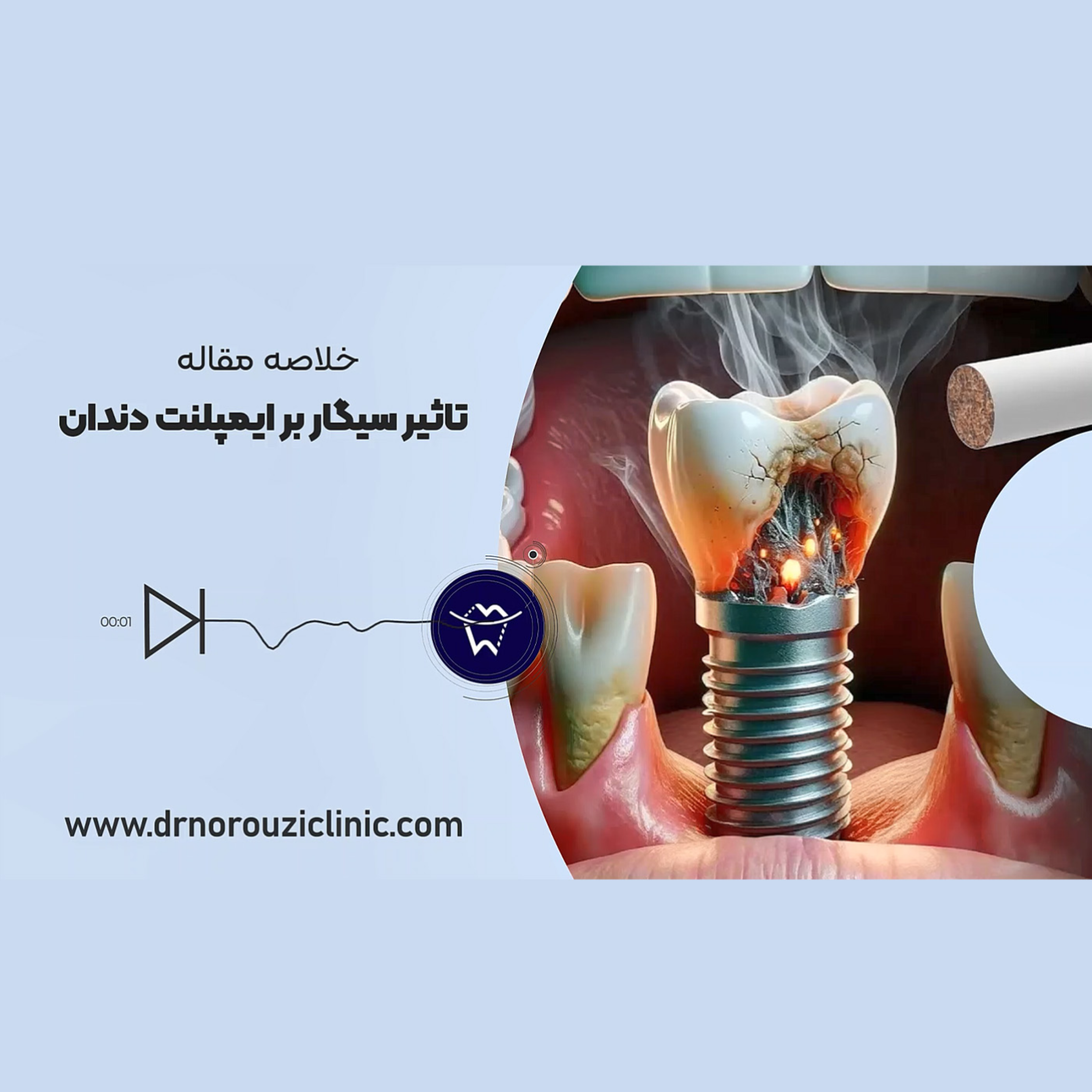 کاور تاثیر سیگار بر ایمپلنت دندان