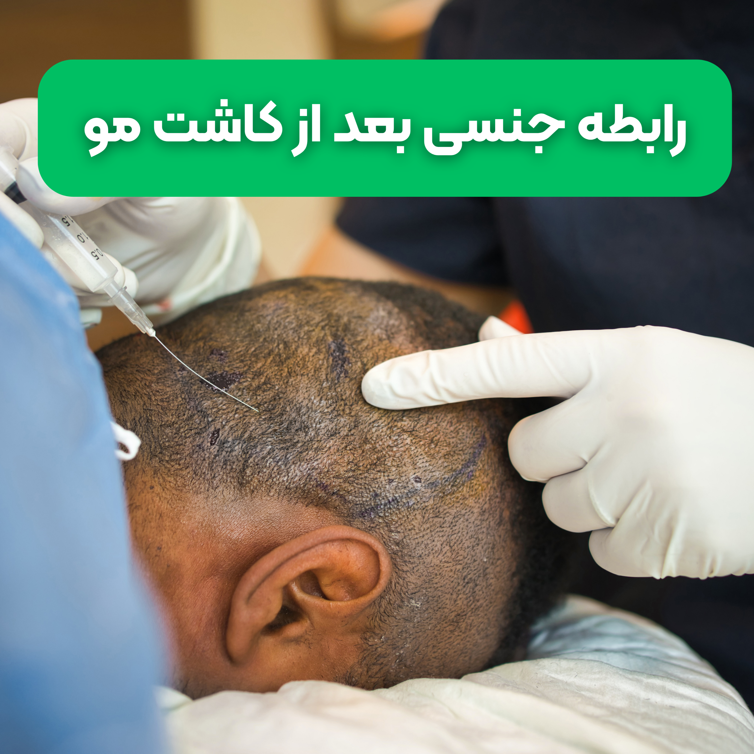 کاور رابطه جنسی بعد از کاشت مو