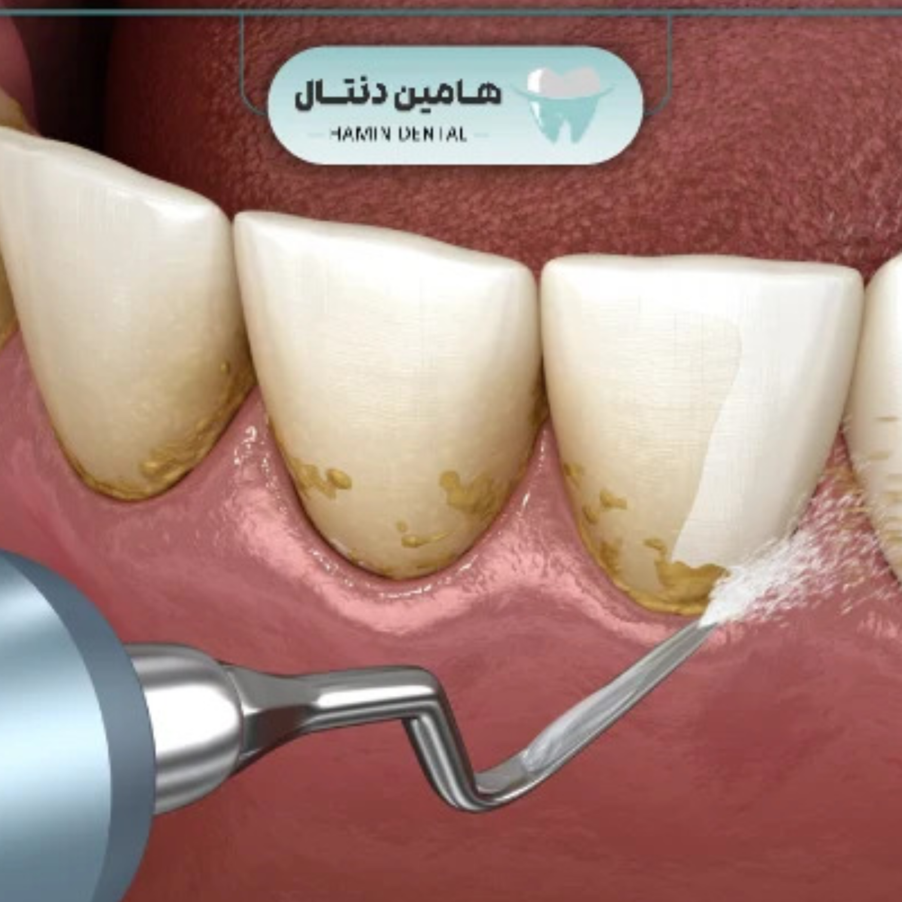 کاور راهنمای خرید جرمگیر دندانپزشکی | معرفی انواع دستگاه جرمگیر