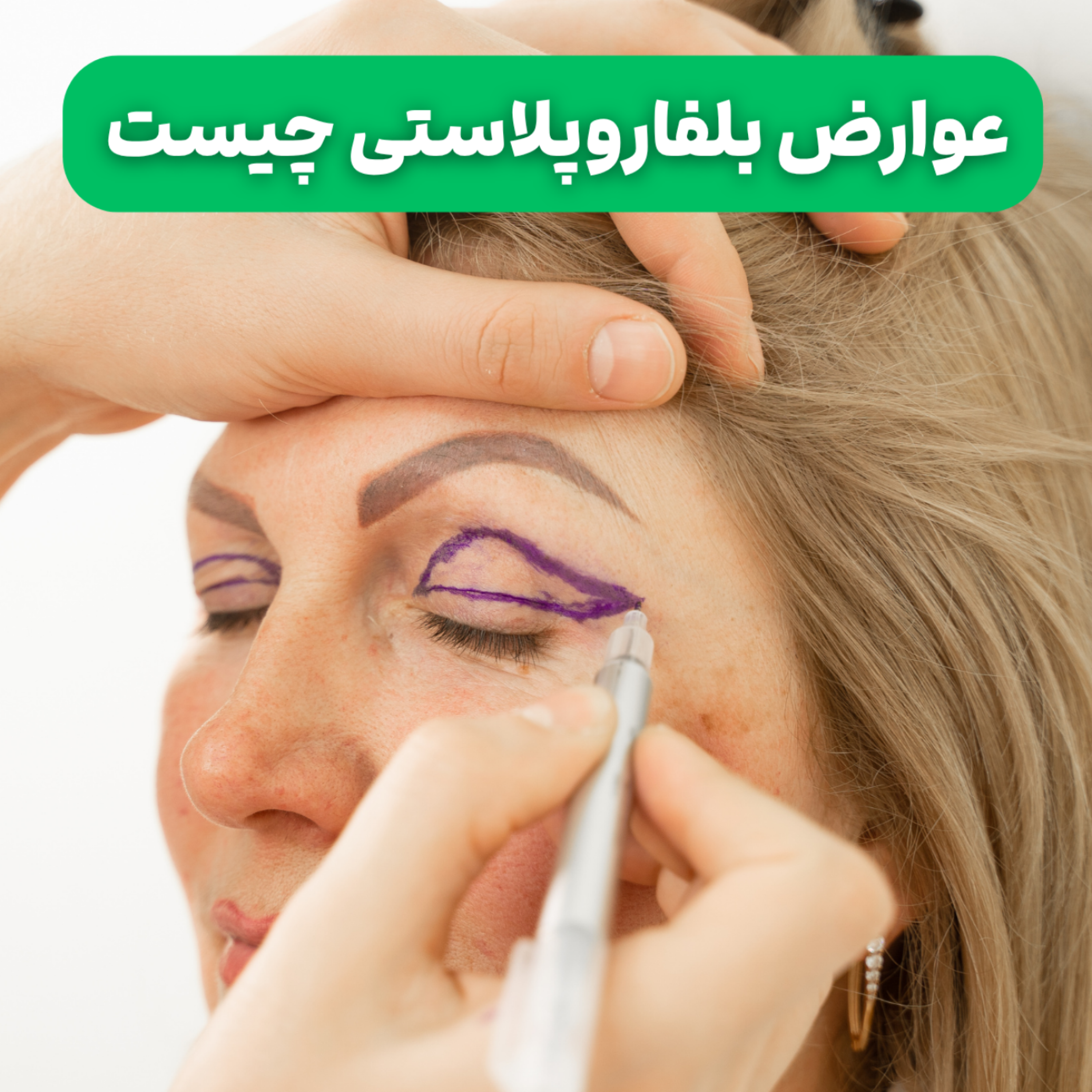 کاور عوارض بلفاروپلاستی چیست