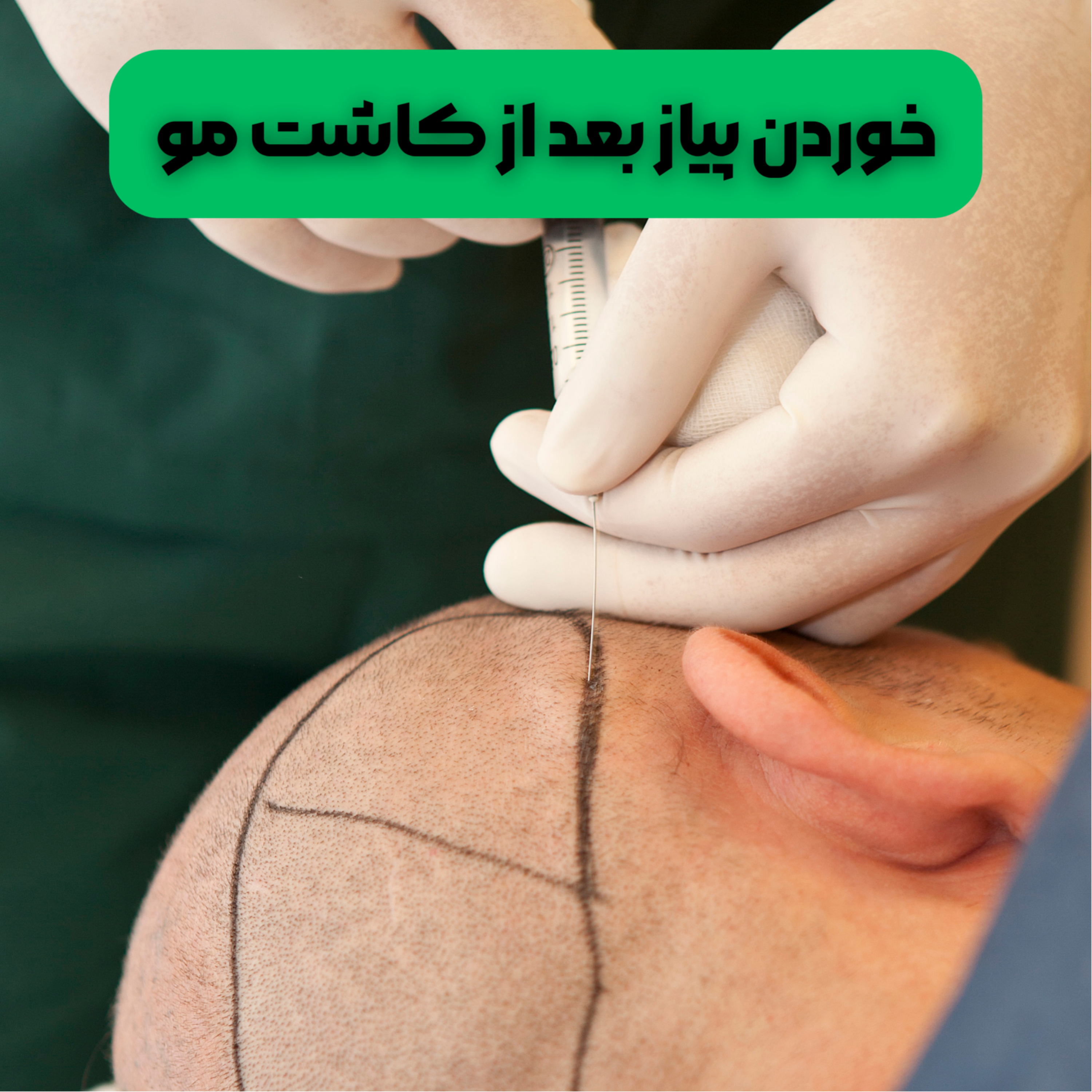 کاور خوردن پیاز بعد از کاشت مو