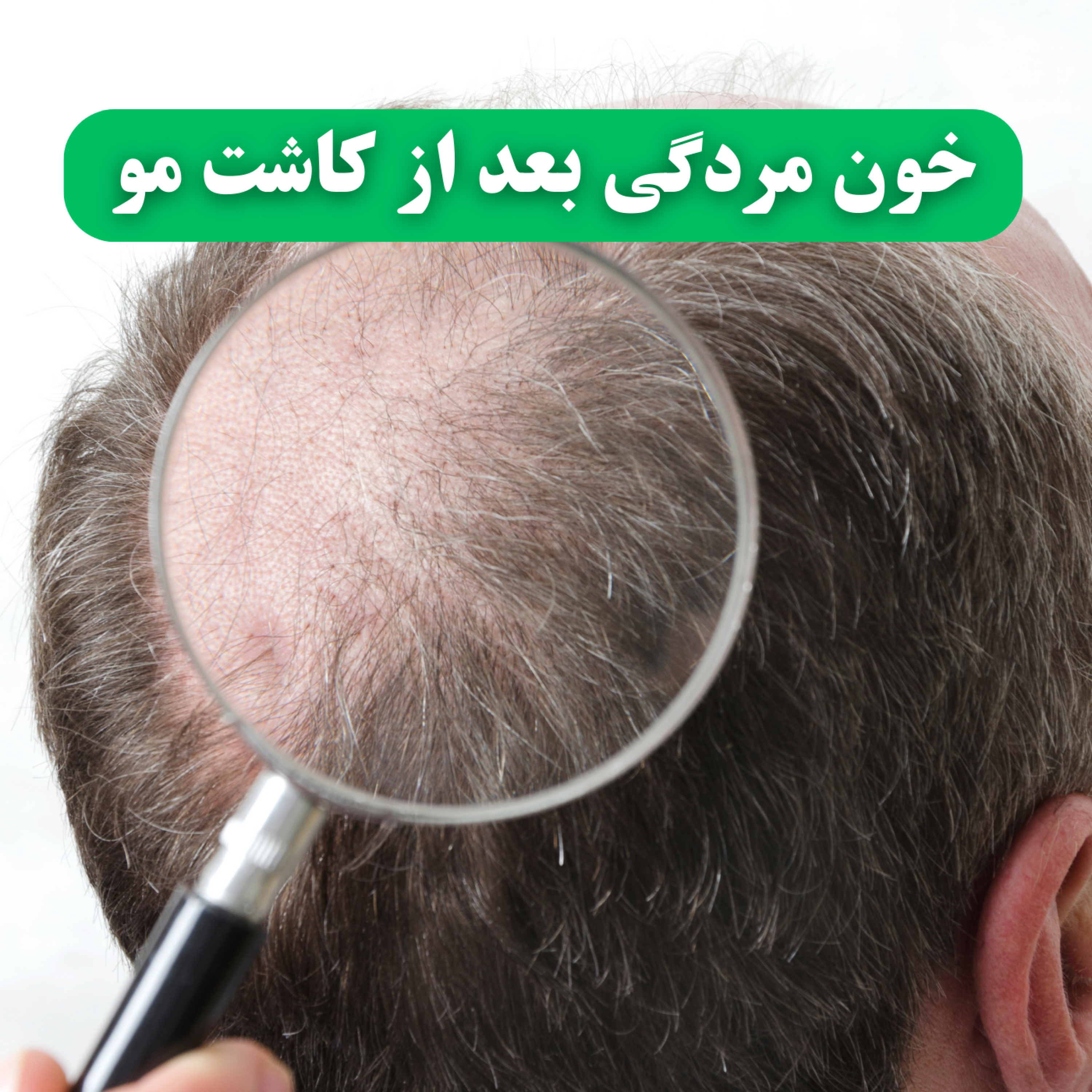 کاور خون مردگی بعد از کاشت مو