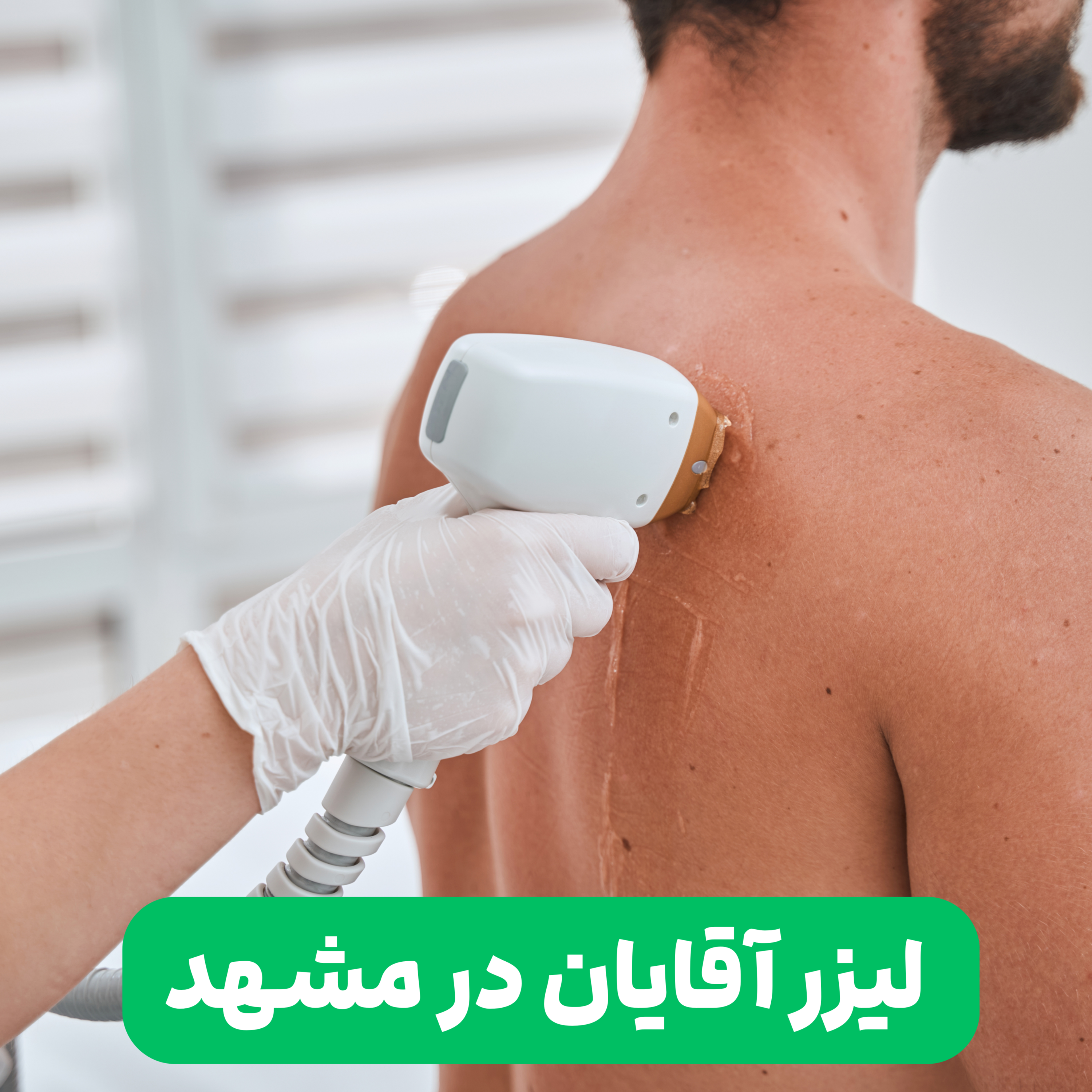 کاور لیزر موهای زائد مردان در نوین ایرانا