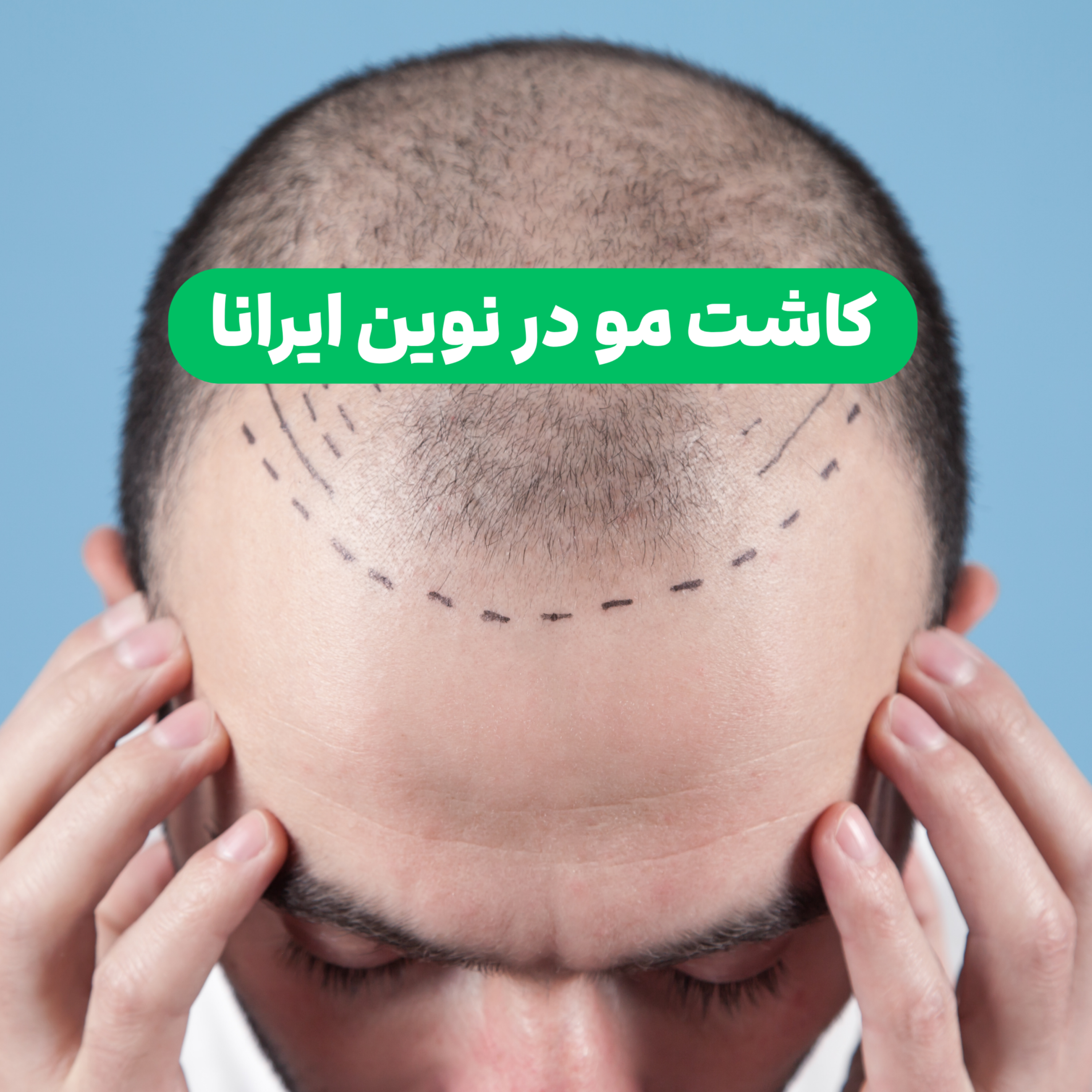 کاور پادکست کاشت مو در نوین ایرانا