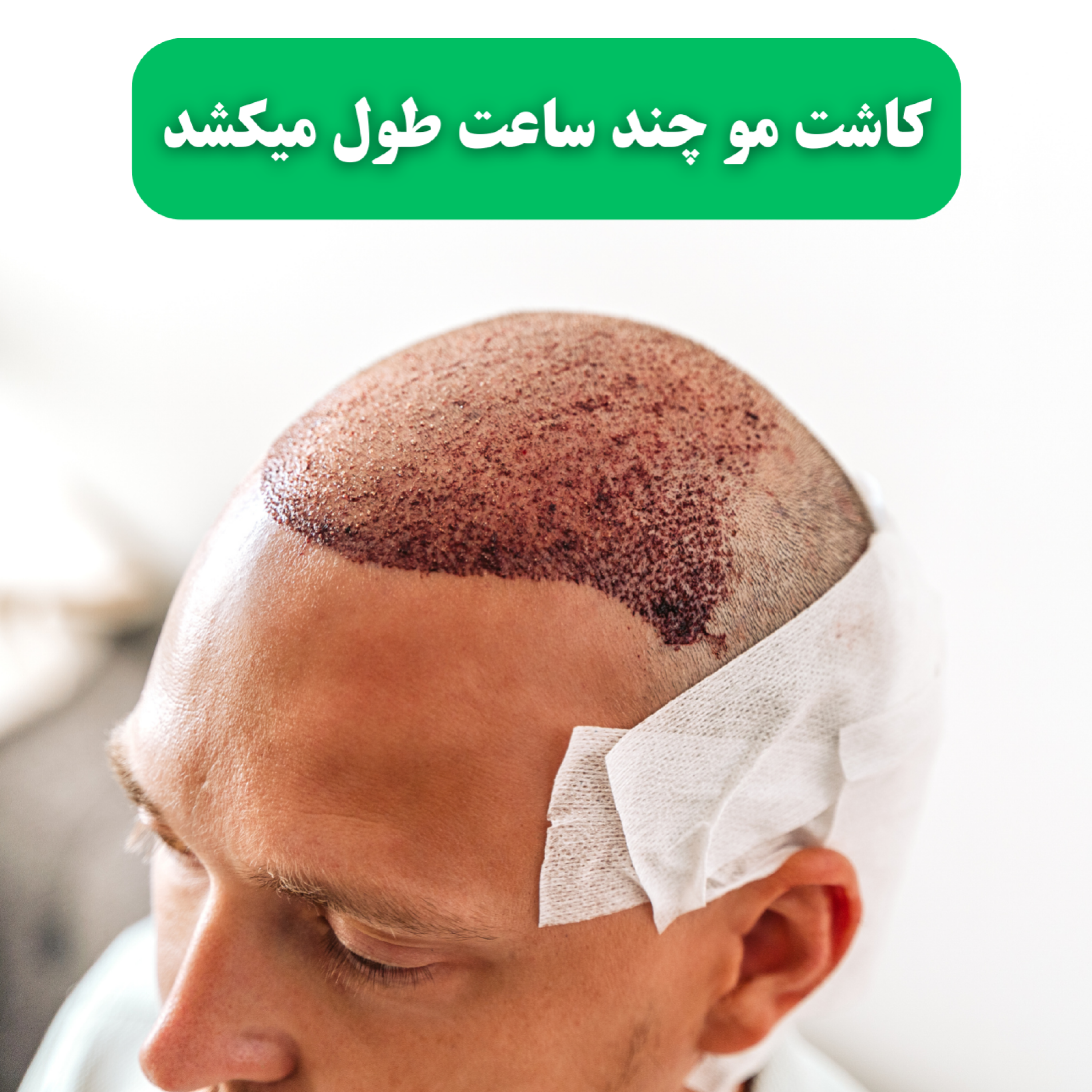کاور کاشت مو چند ساعت طول میکشد