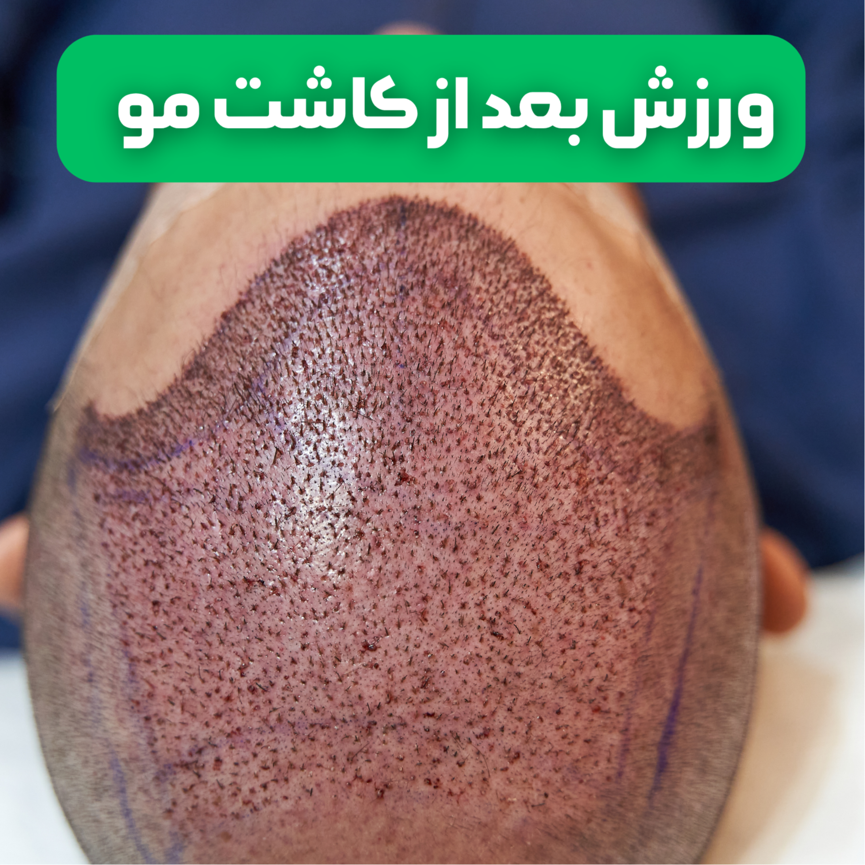 کاور آیا ورزش بعد از کاشت مو خطر دارد