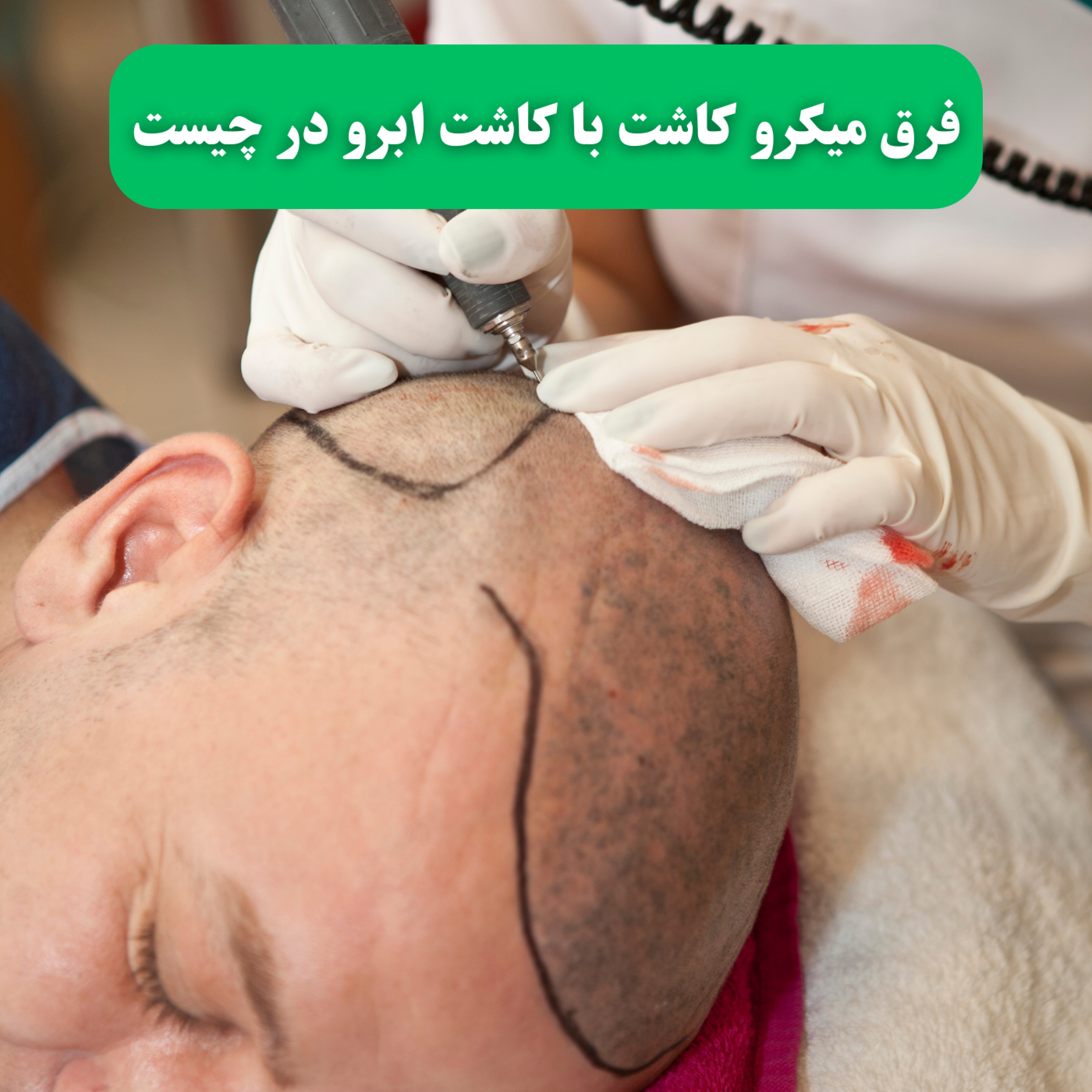 کاور چند روز بعد از کاشت مو میتوان راحت خوابید