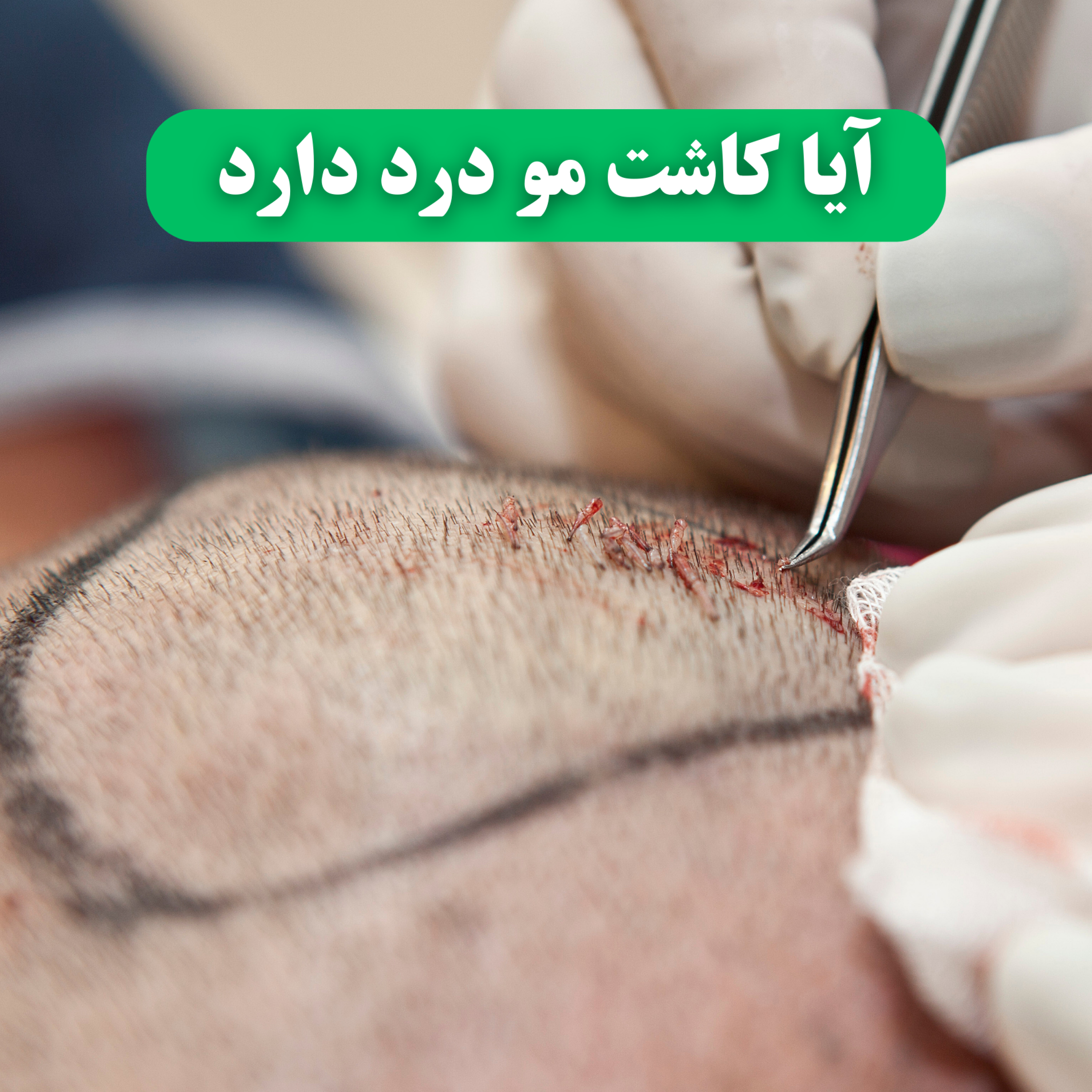 کاور آیا کاشت مو درد دارد