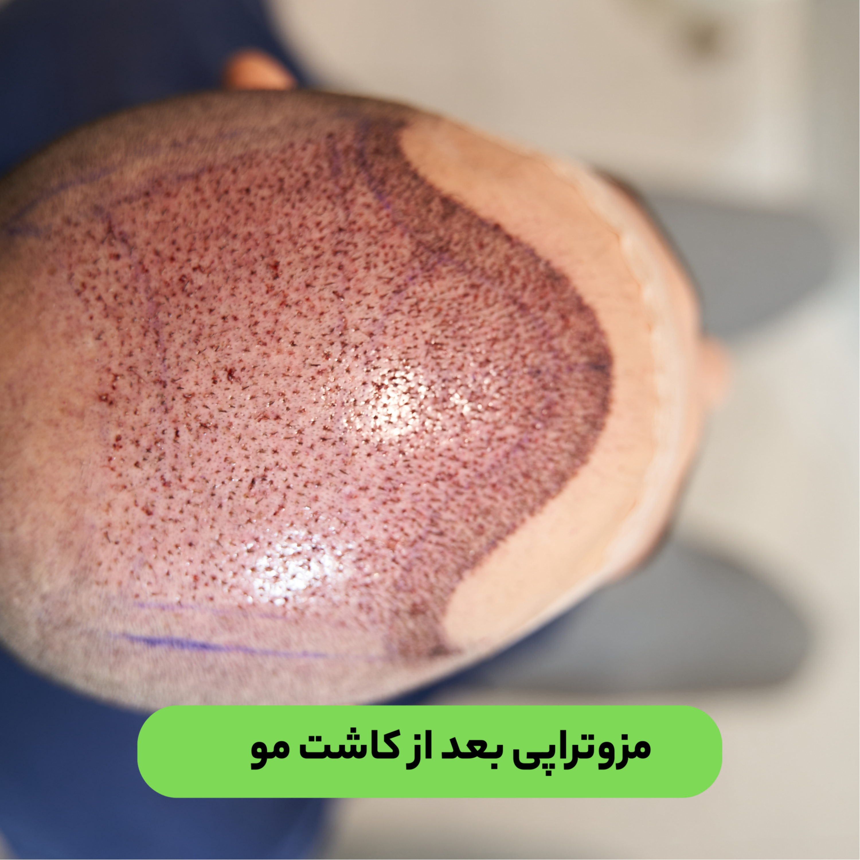 کاور مزوتراپی بعد از کاشت مو