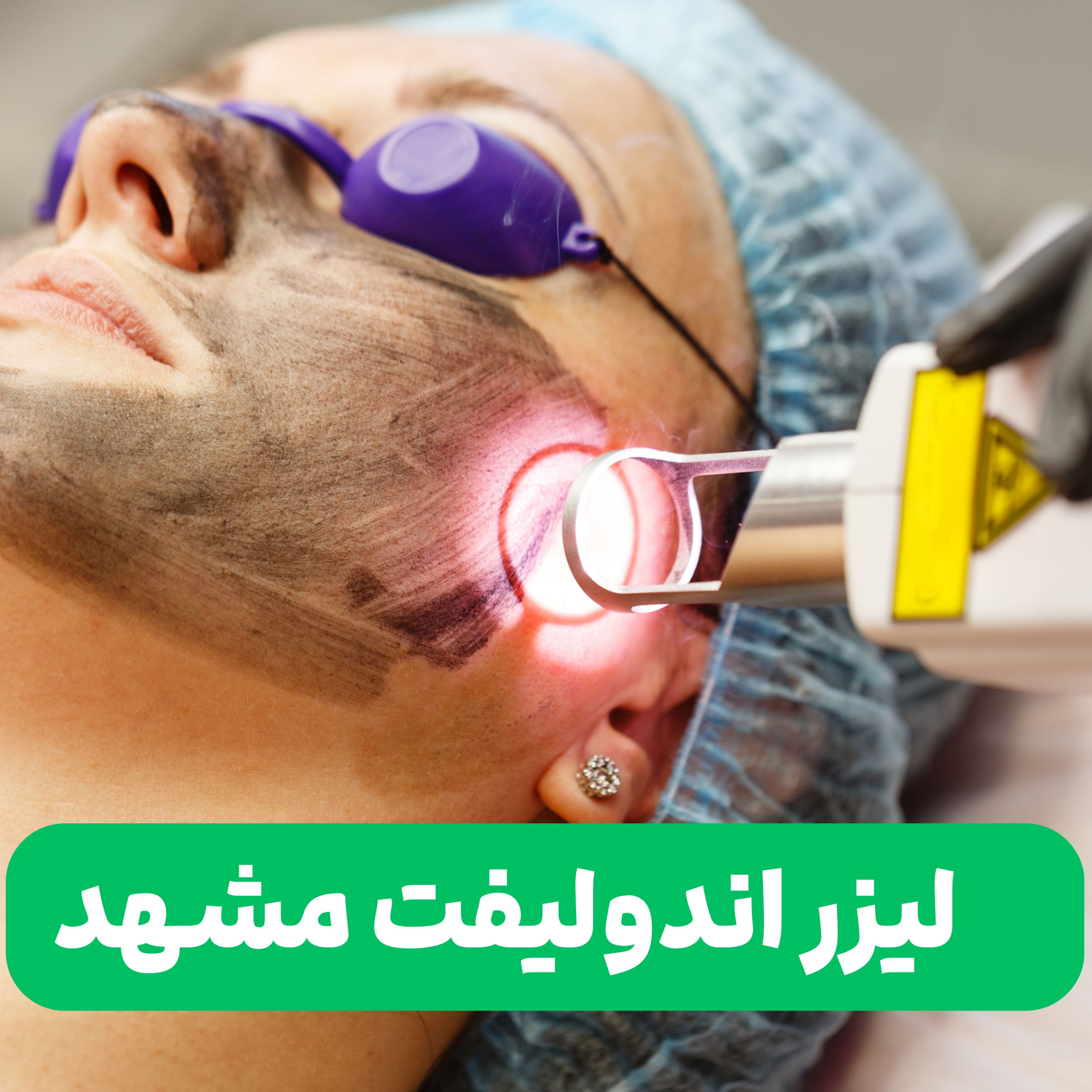 کاور لیزر اندولیفت در کلینیک نوین ایرانا