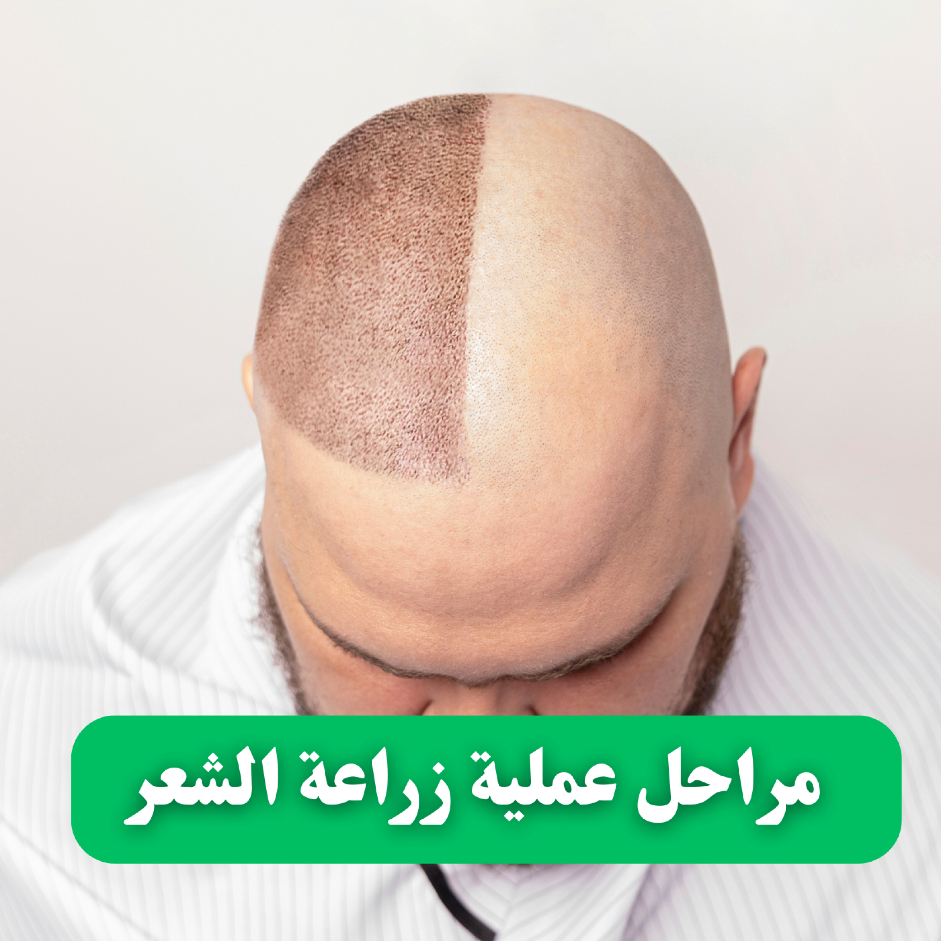 کاور مراحل عملية زراعة الشعر