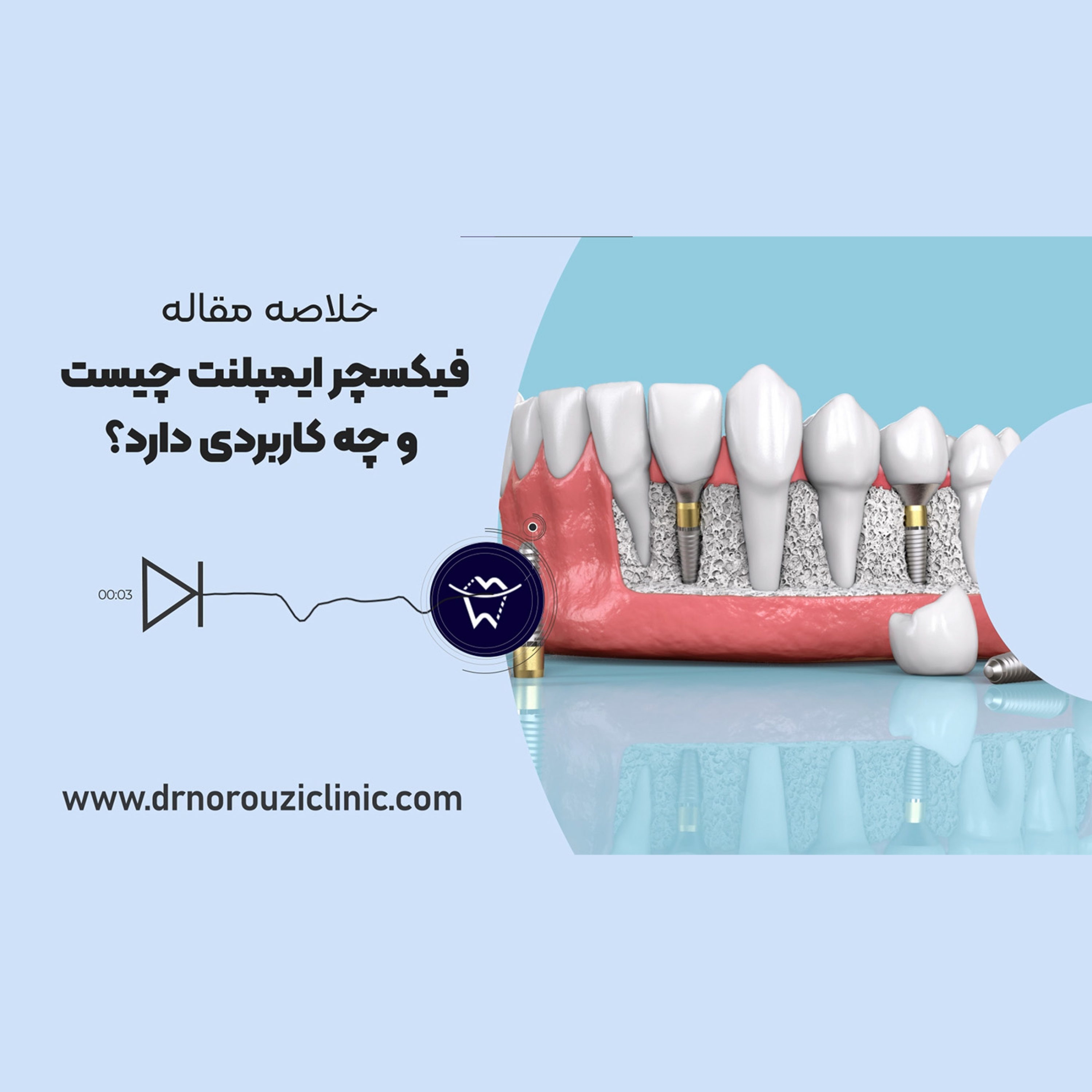 کاور فیکسچر ایمپلنت چیست و چه کاربرد دارد؟