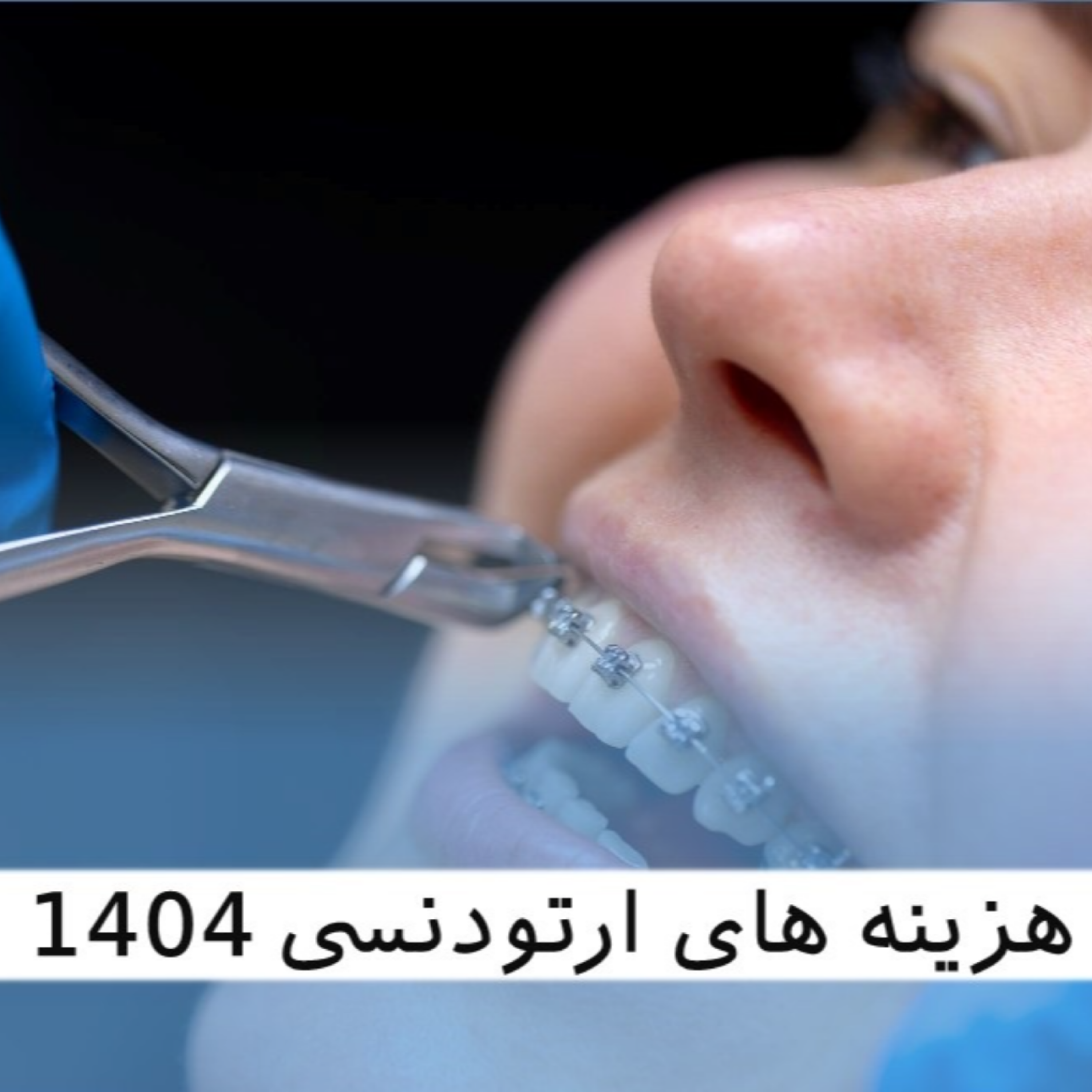 کاور راهنمای جامع هزینه های ارتودنسی 1404