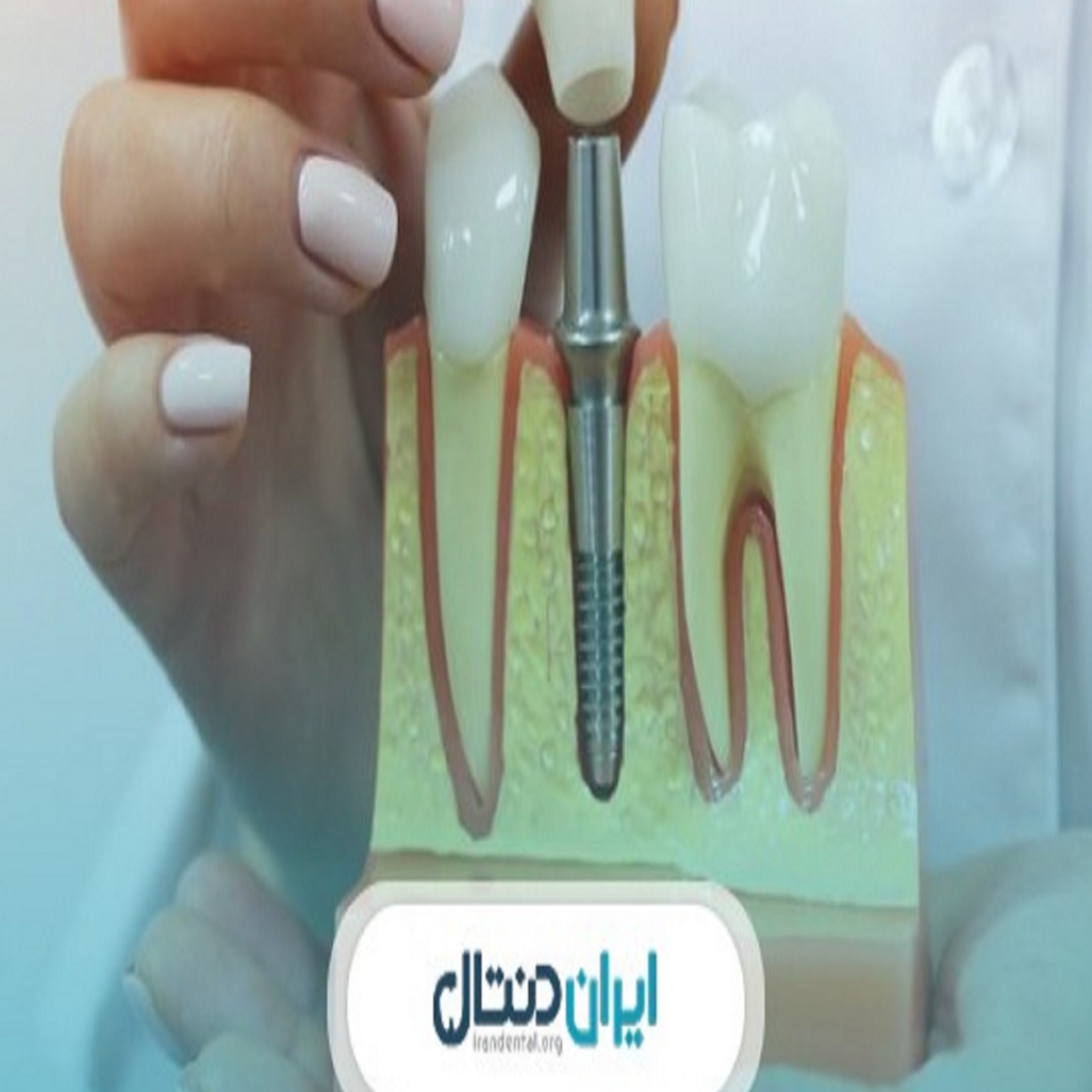 کاور بهترین دکتر ایمپلنت در رشت