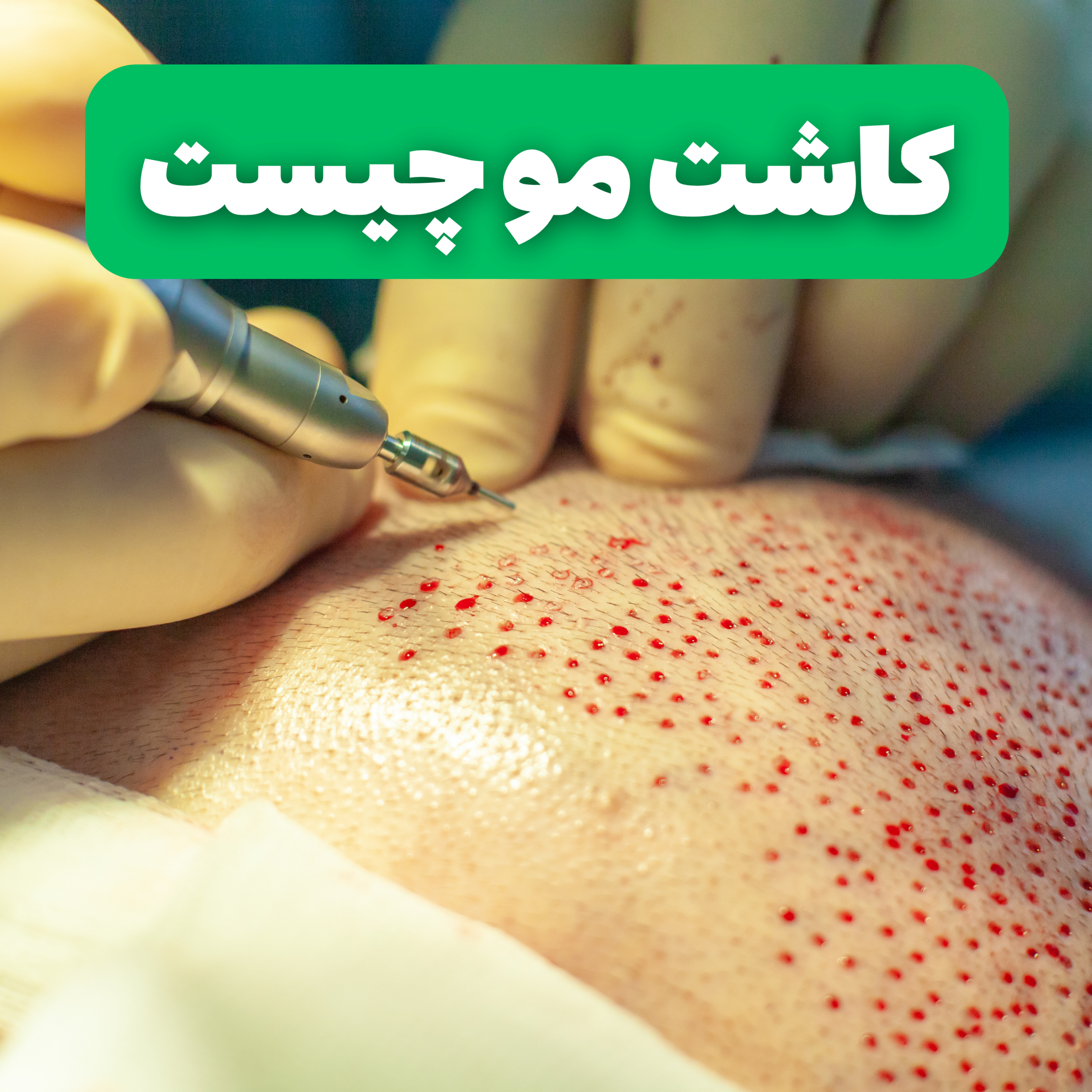 کاور کاشت مو چیست