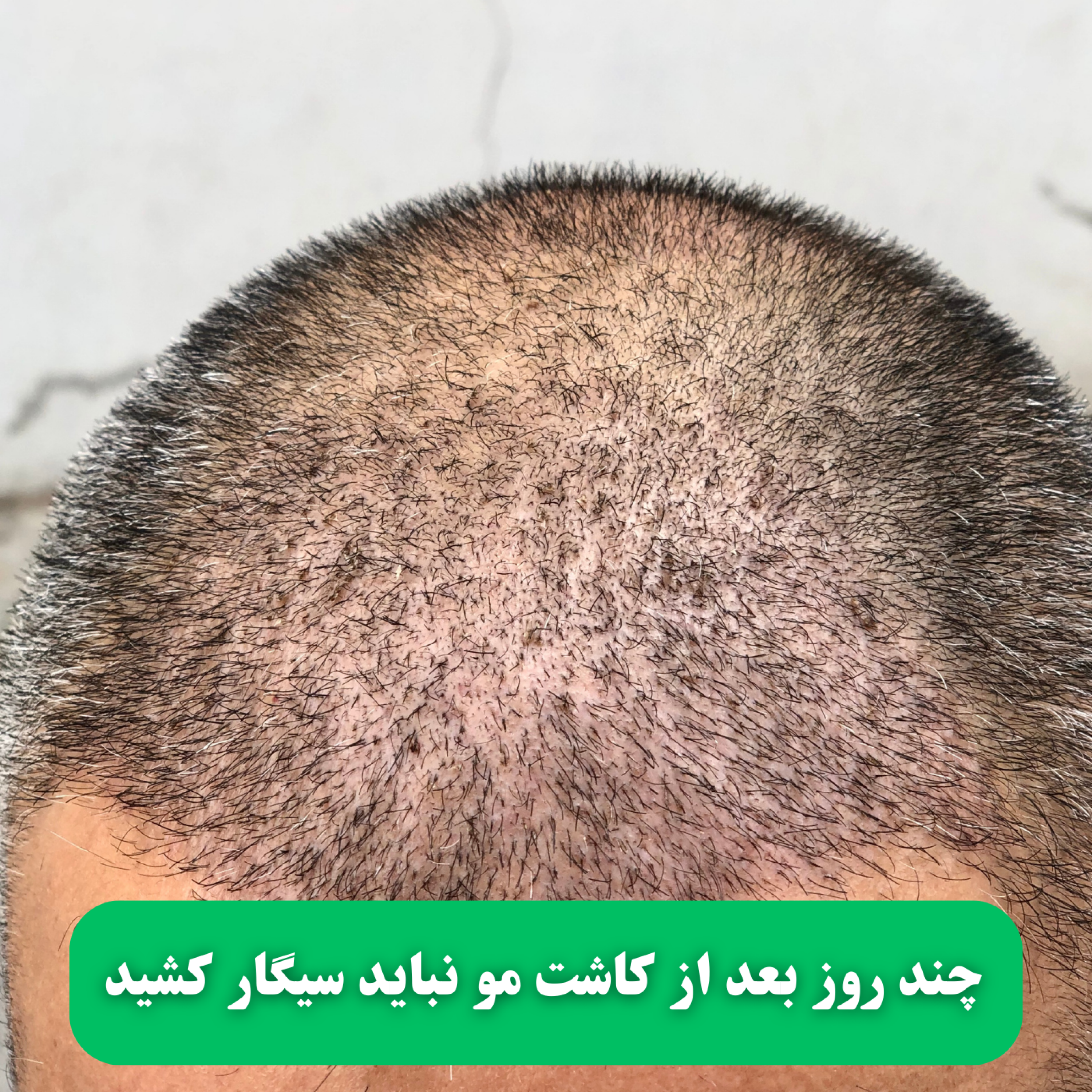 کاور چند روز بعد از کاشت مو نباید سیگار کشید