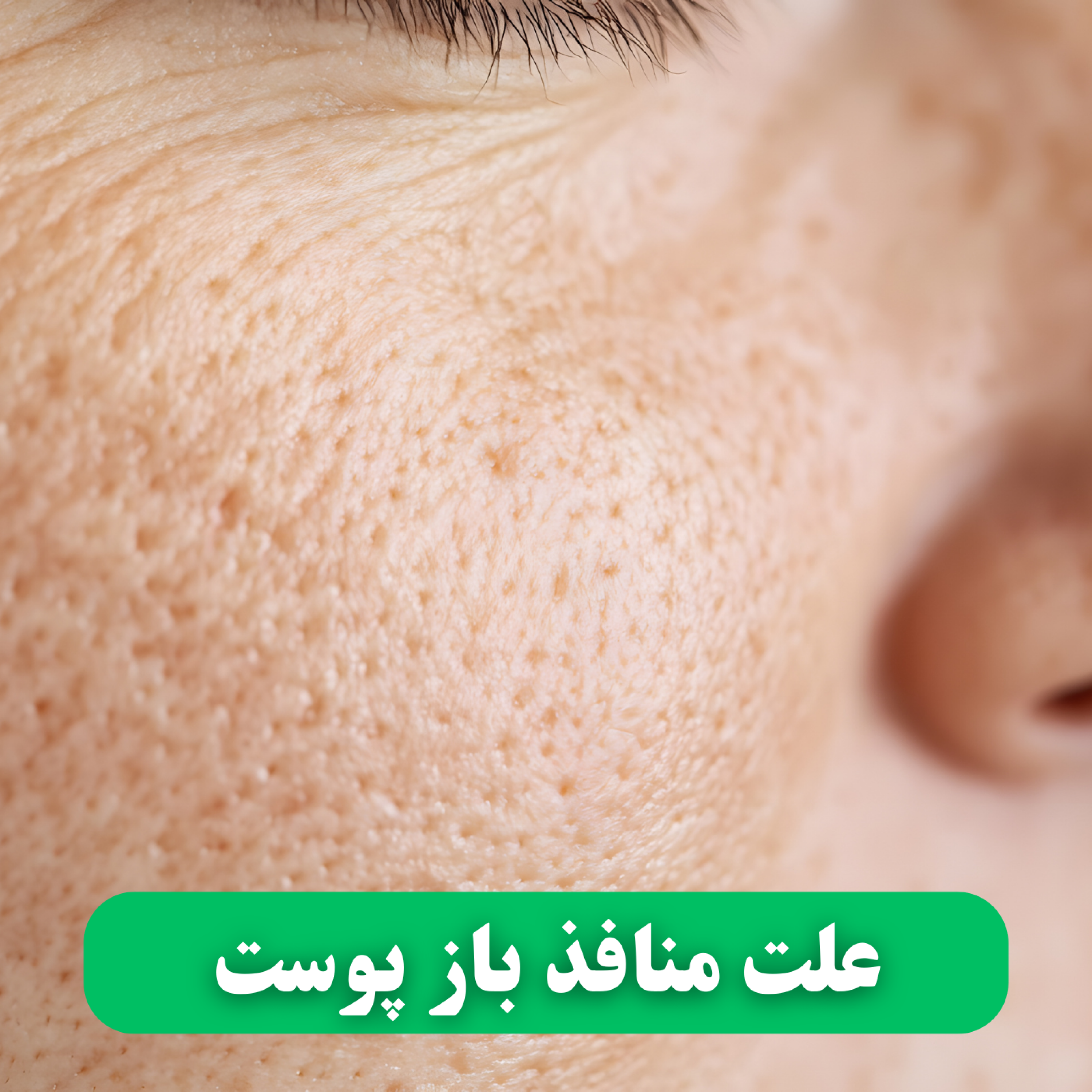 کاور علت منافذ باز پوست چیست؟