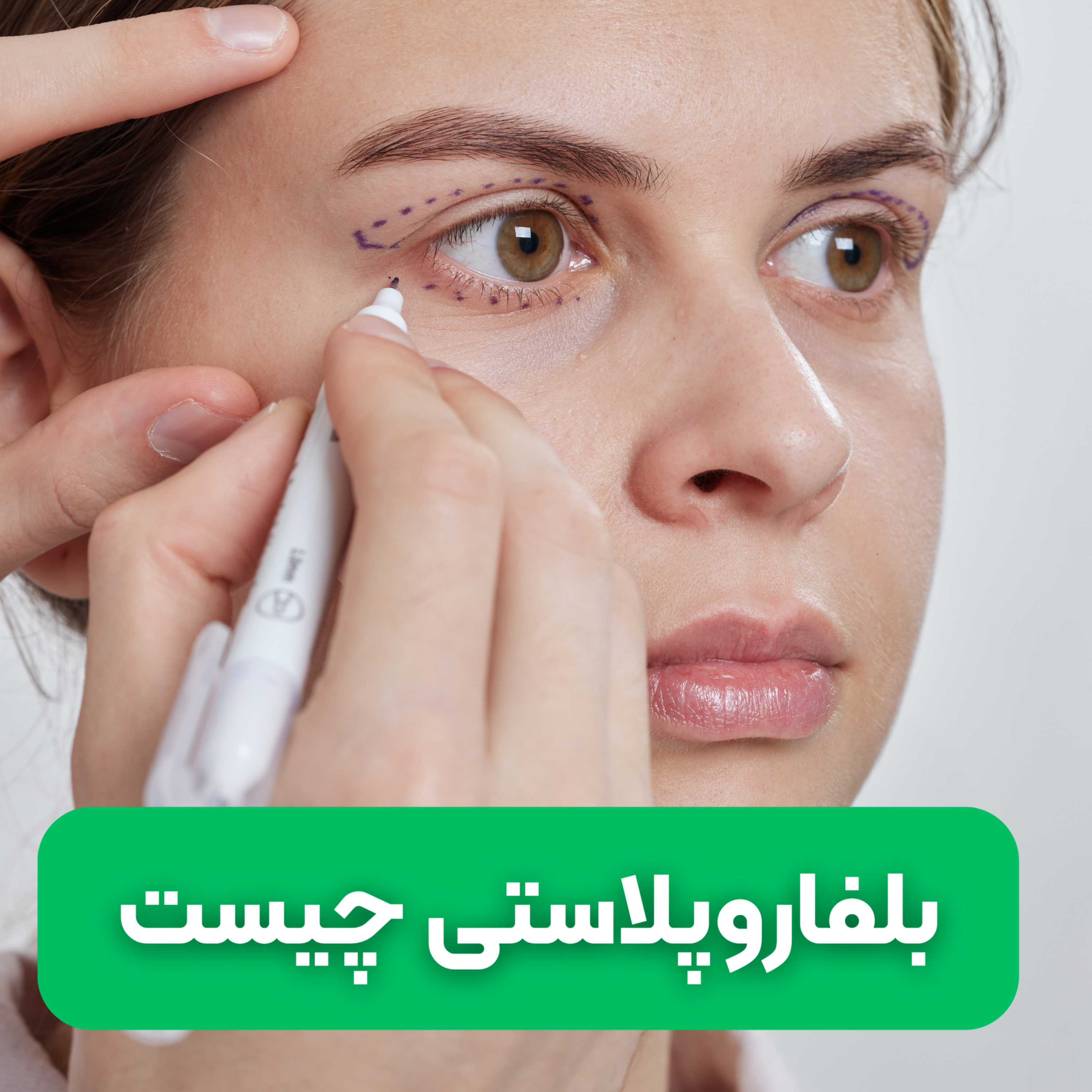 کاور بلفاروپلاستی چیست؟ انواع آن و هزینه انجام عمل آن