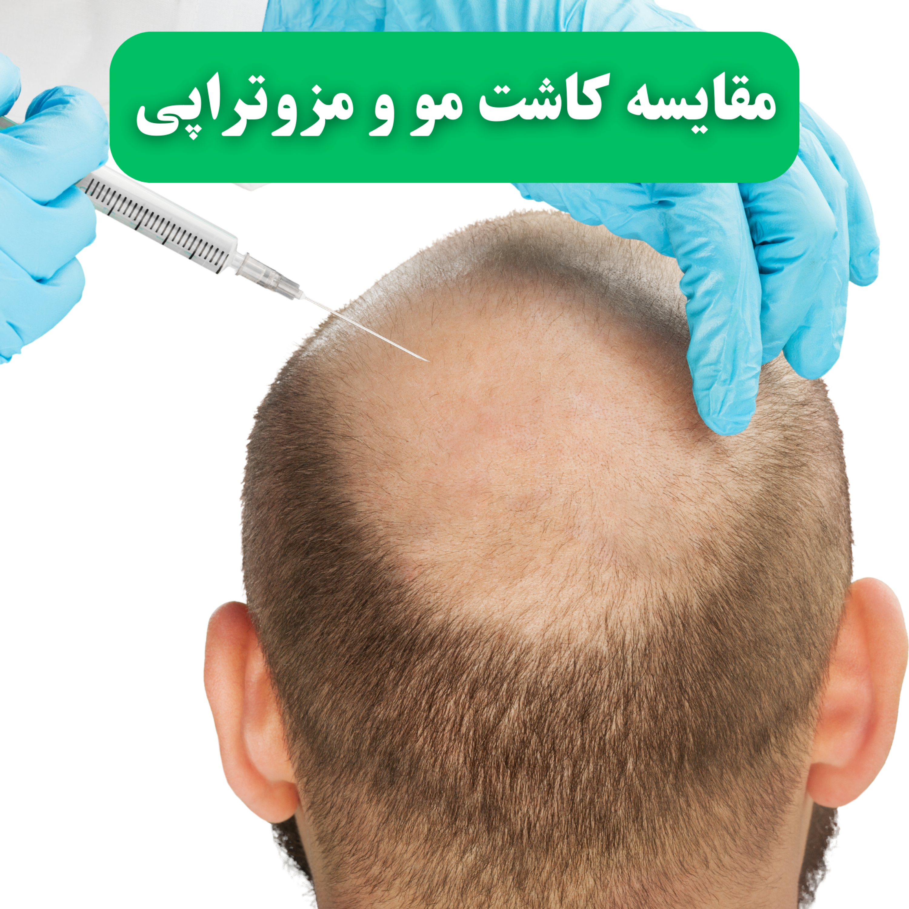 کاور مقایسه کاشت مو و مزوتراپی