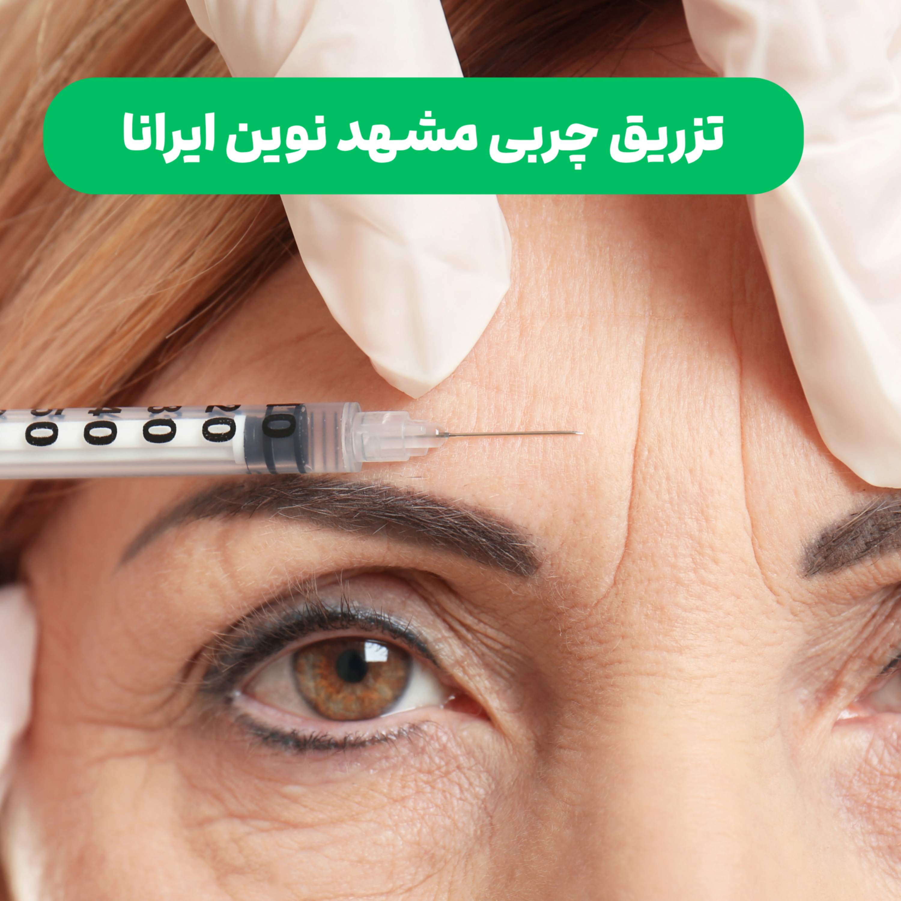 کاور پادکست تزریق چربی مشهد