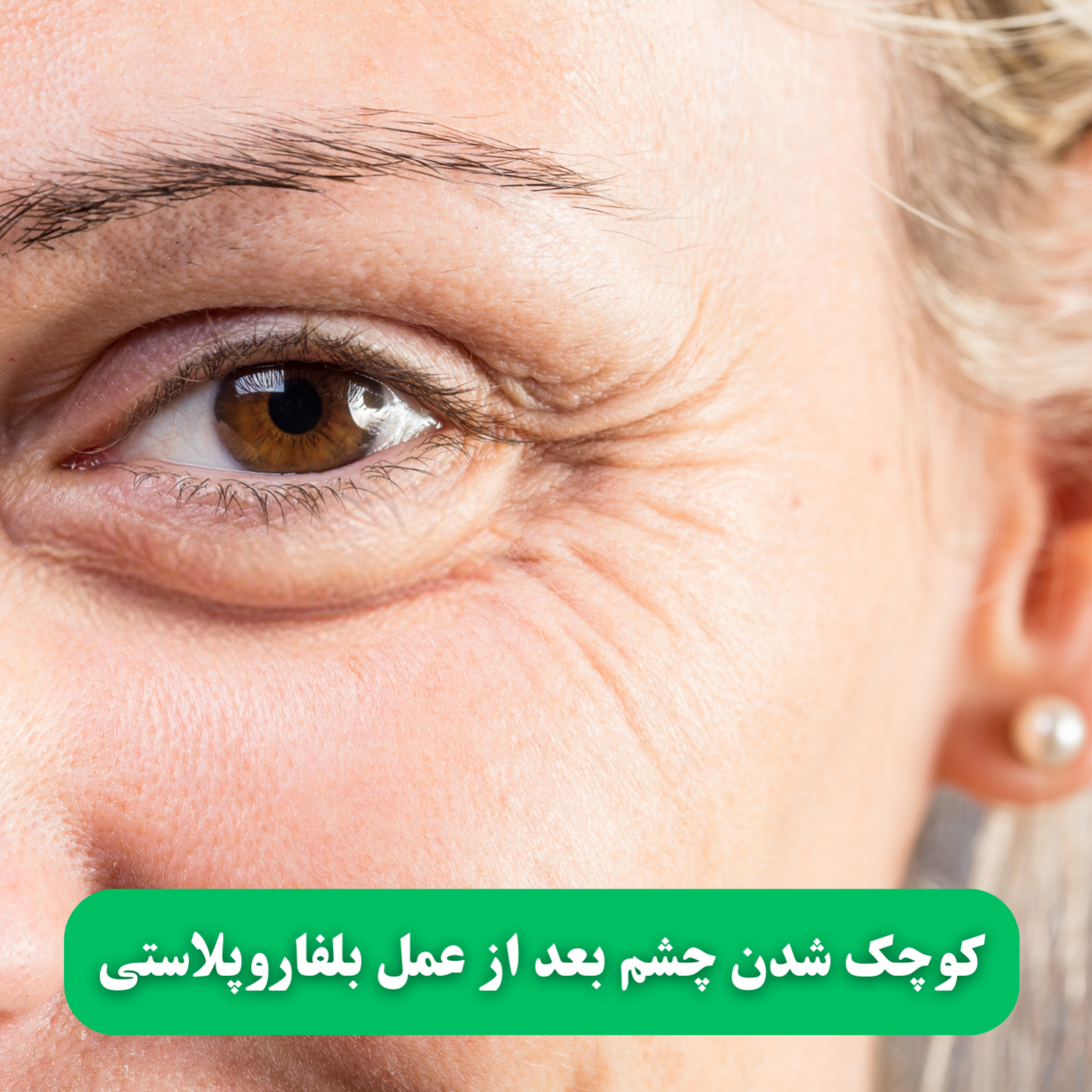 کاور کوچک شدن چشم بعد از عمل بلفاروپلاستی