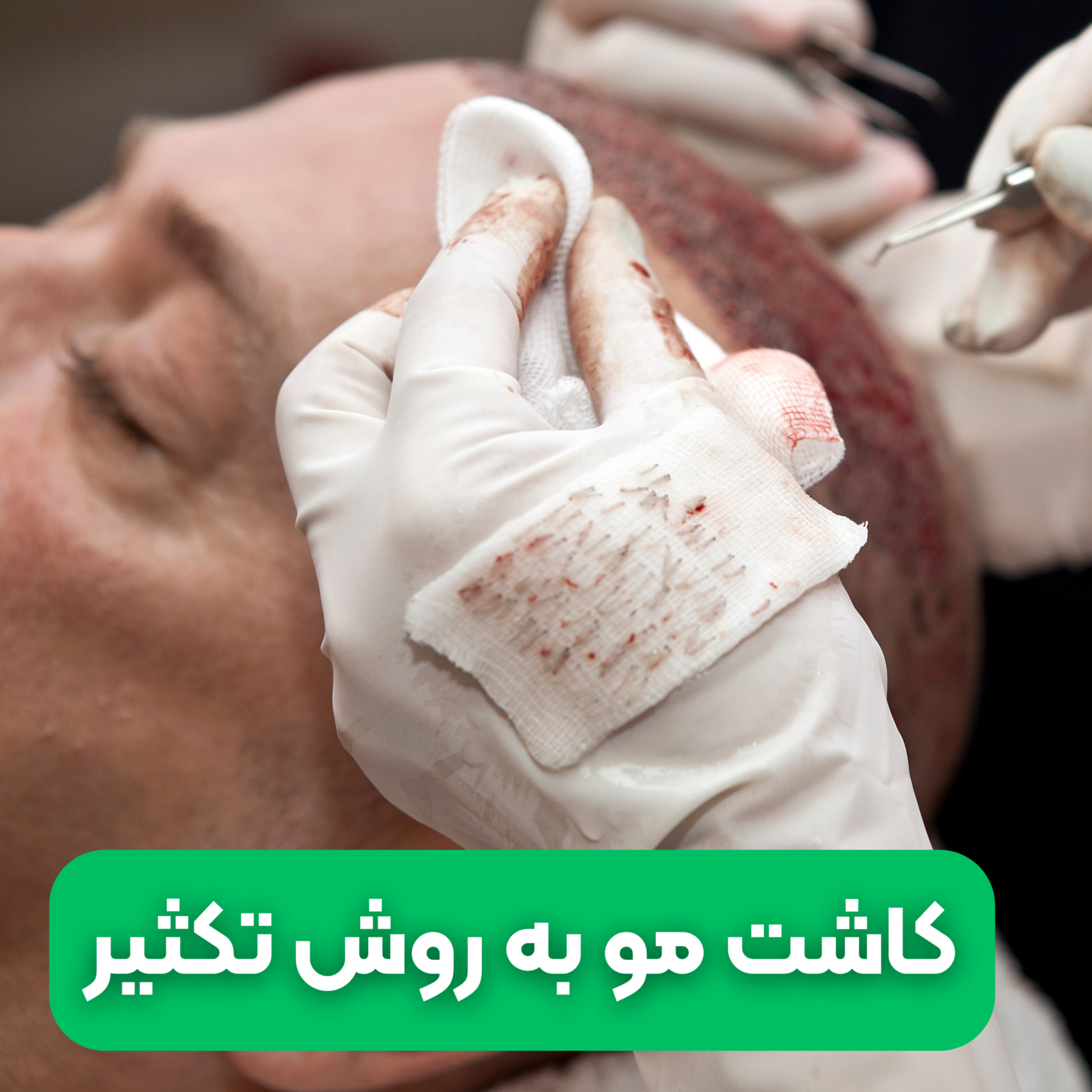 کاور کاشت مو به روش تکثیر