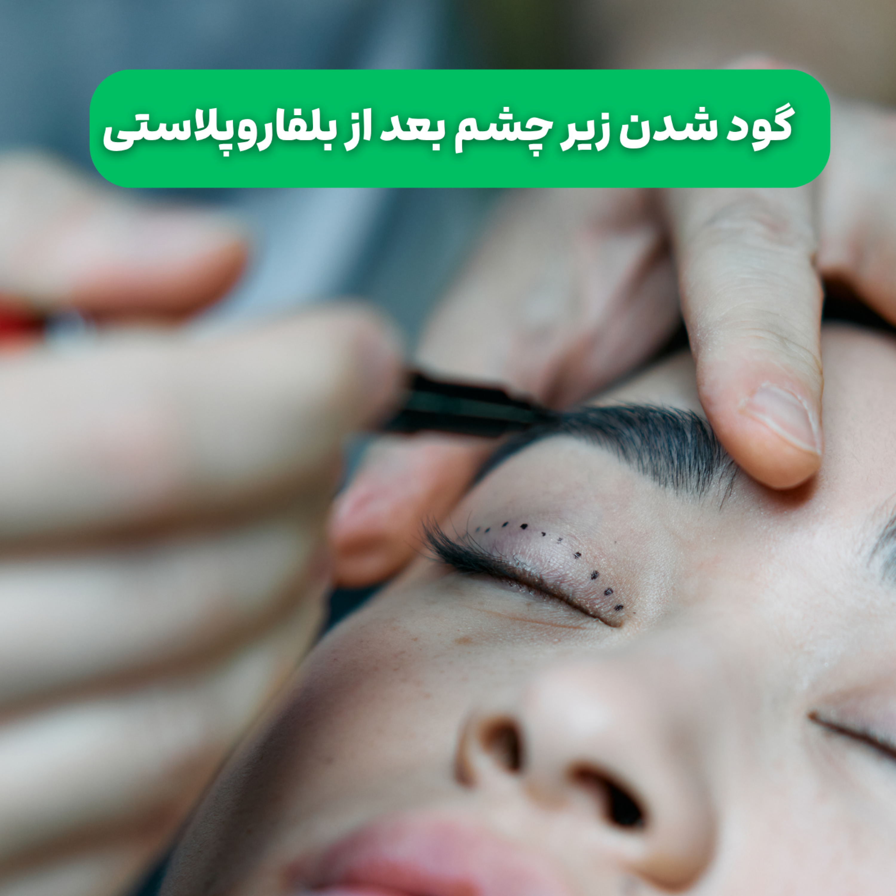 کاور گود شدن زیر چشم بعد از بلفاروپلاستی