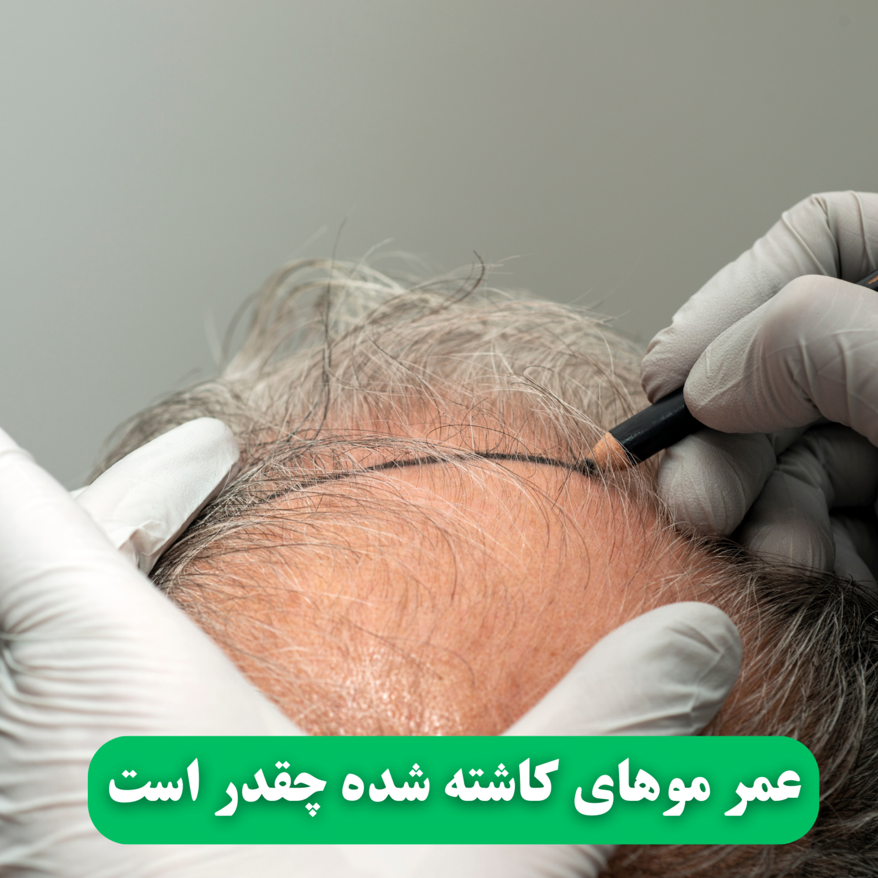 کاور عمر موهای کاشته شده چقدر است