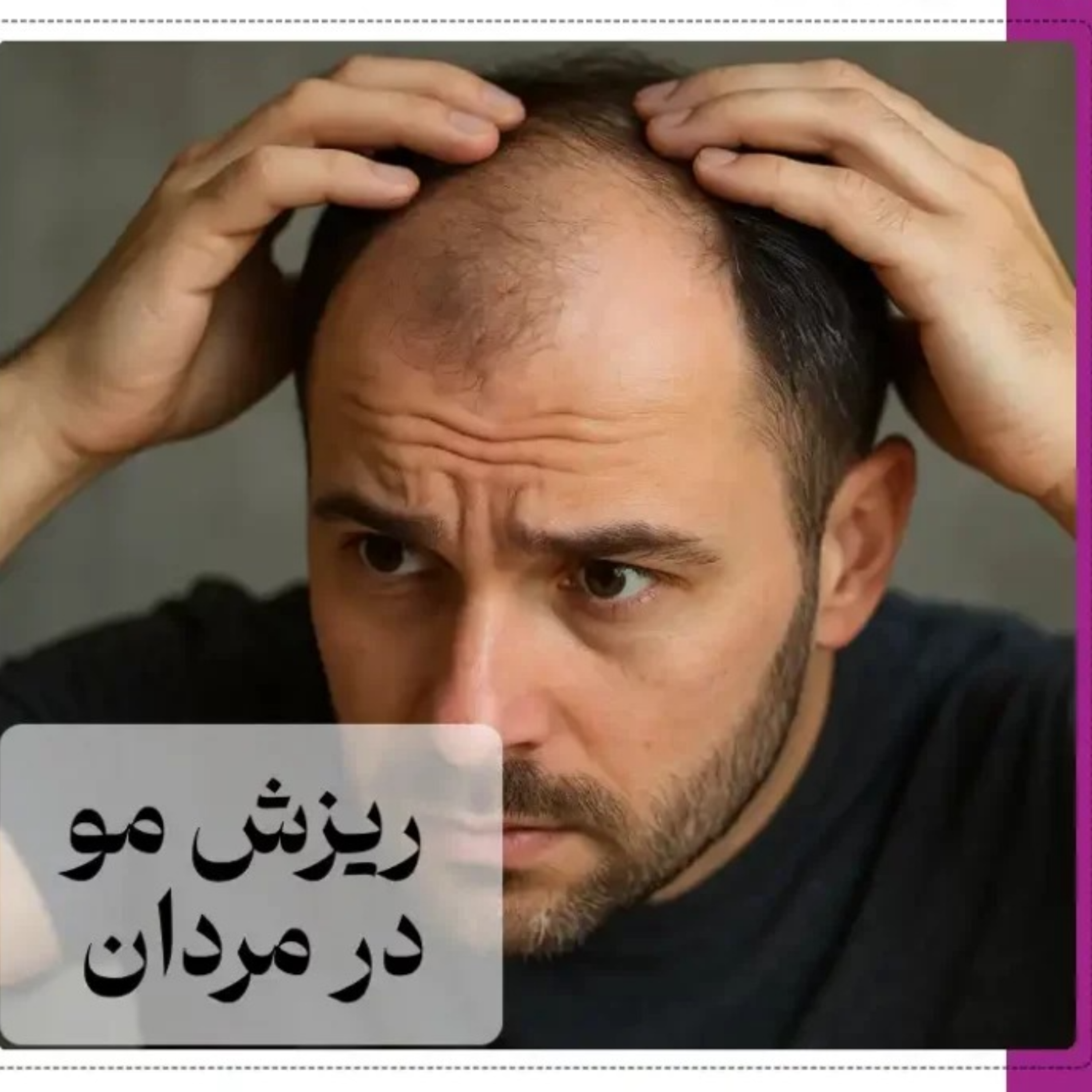 کاور علل ریزش مو در مردان