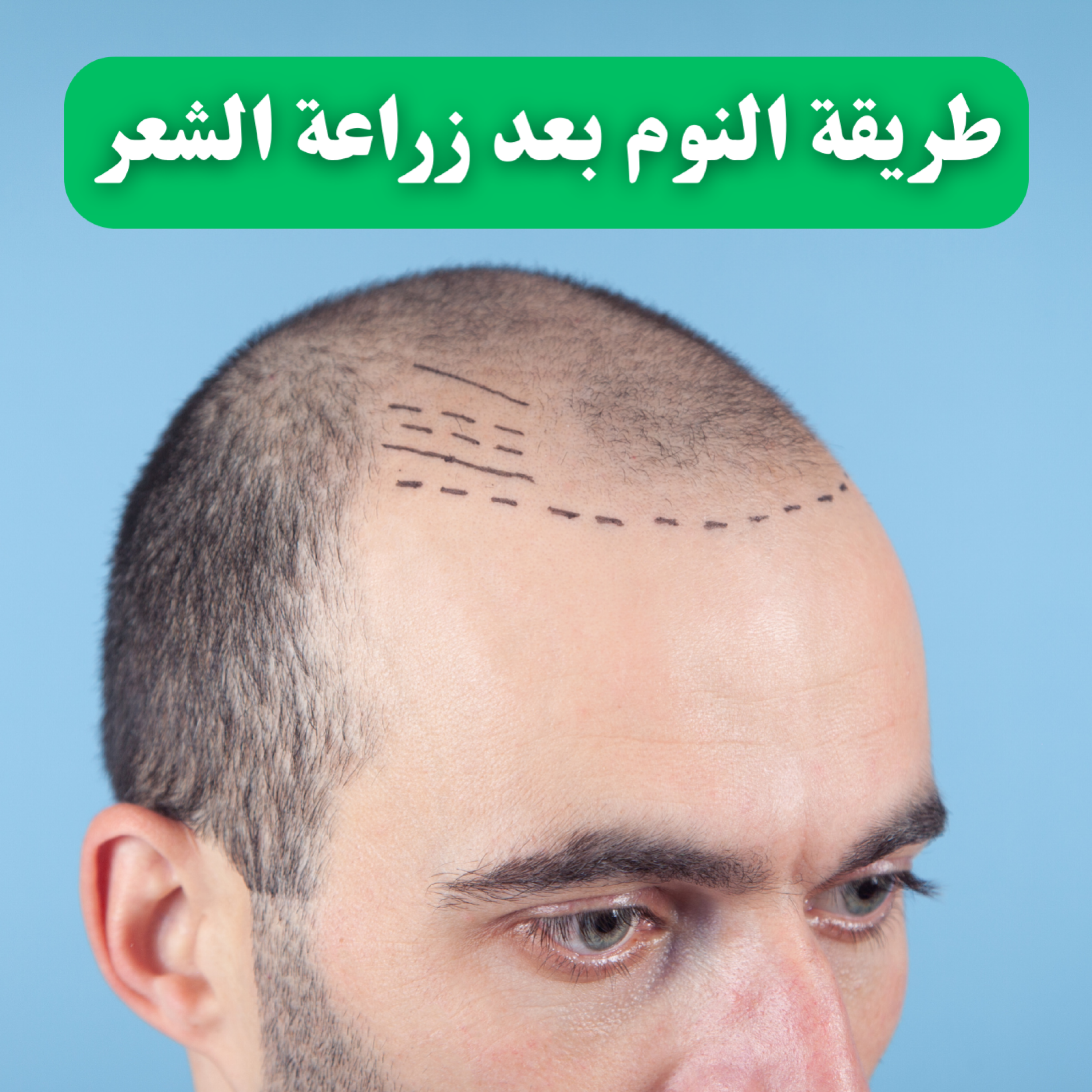 کاور طريقة النوم بعد زراعة الشعر