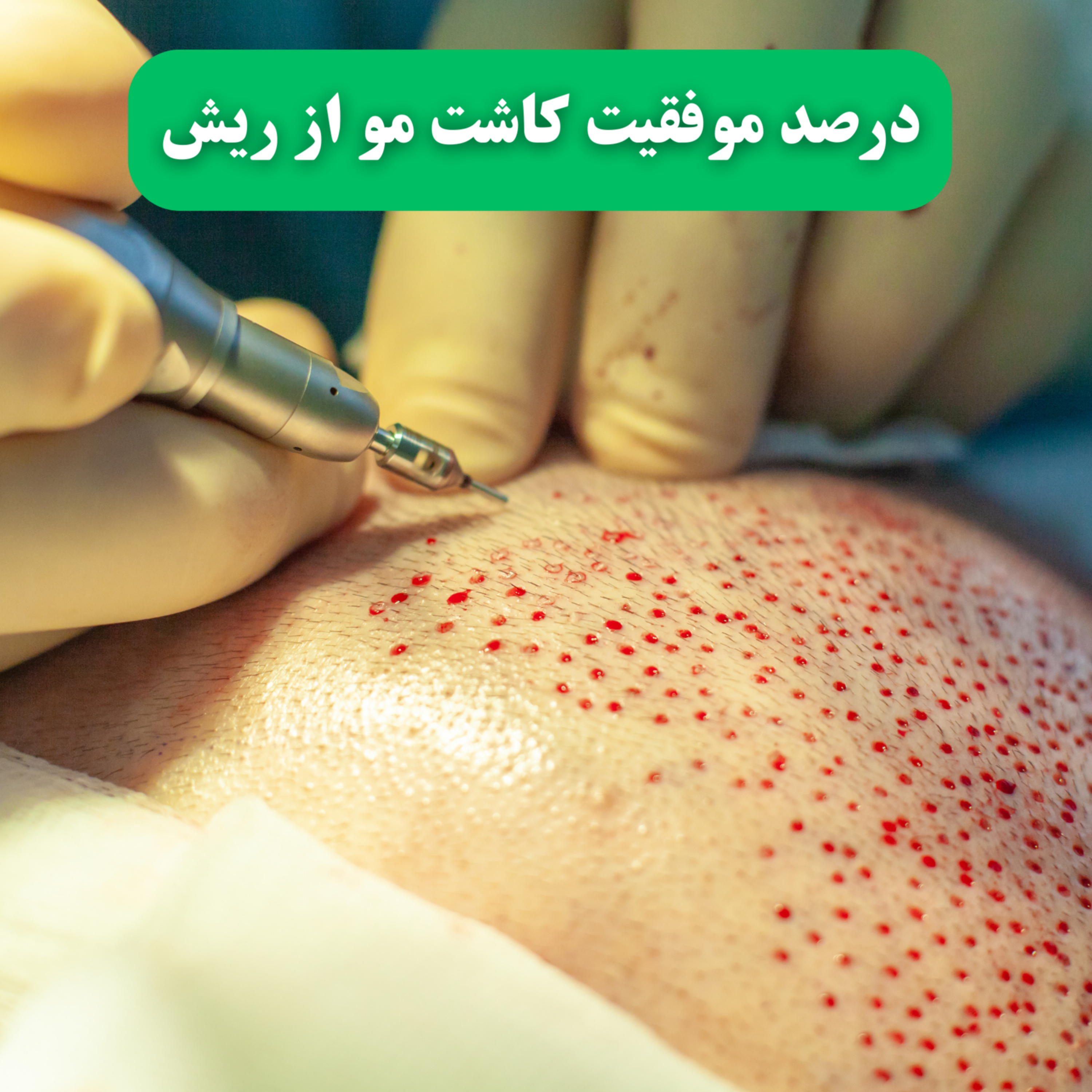 کاور درصد موفقیت کاشت مو از ریش