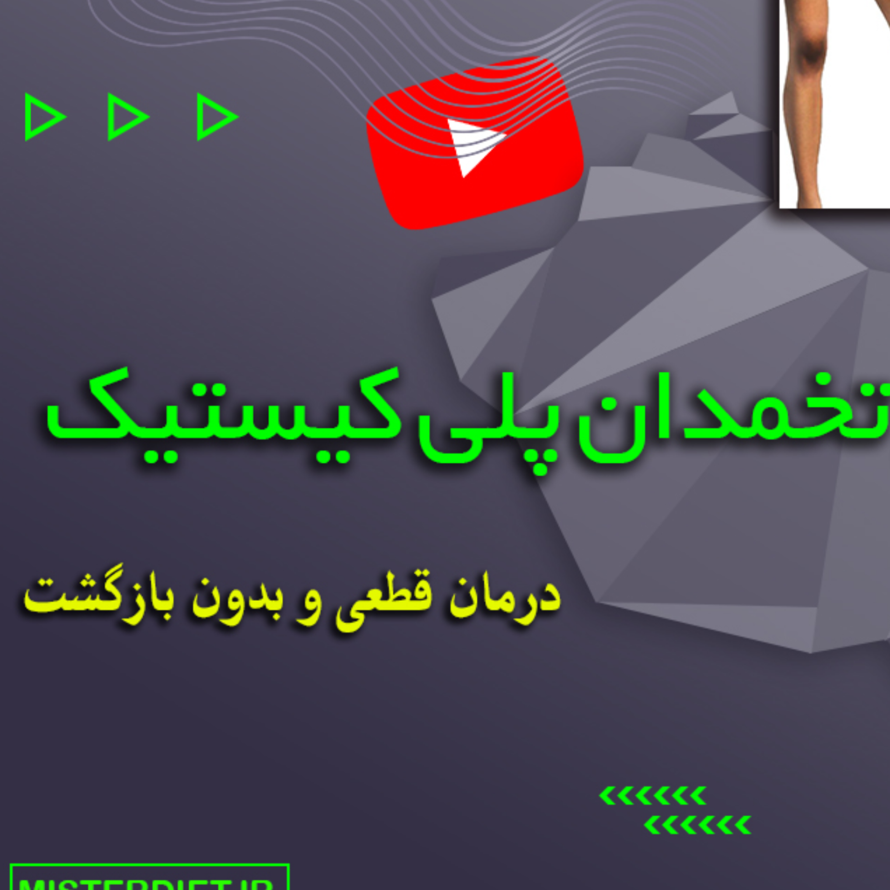 کاور بیماری سندرم تخمدان پلی کیستیک یا تنبلی تخمدان