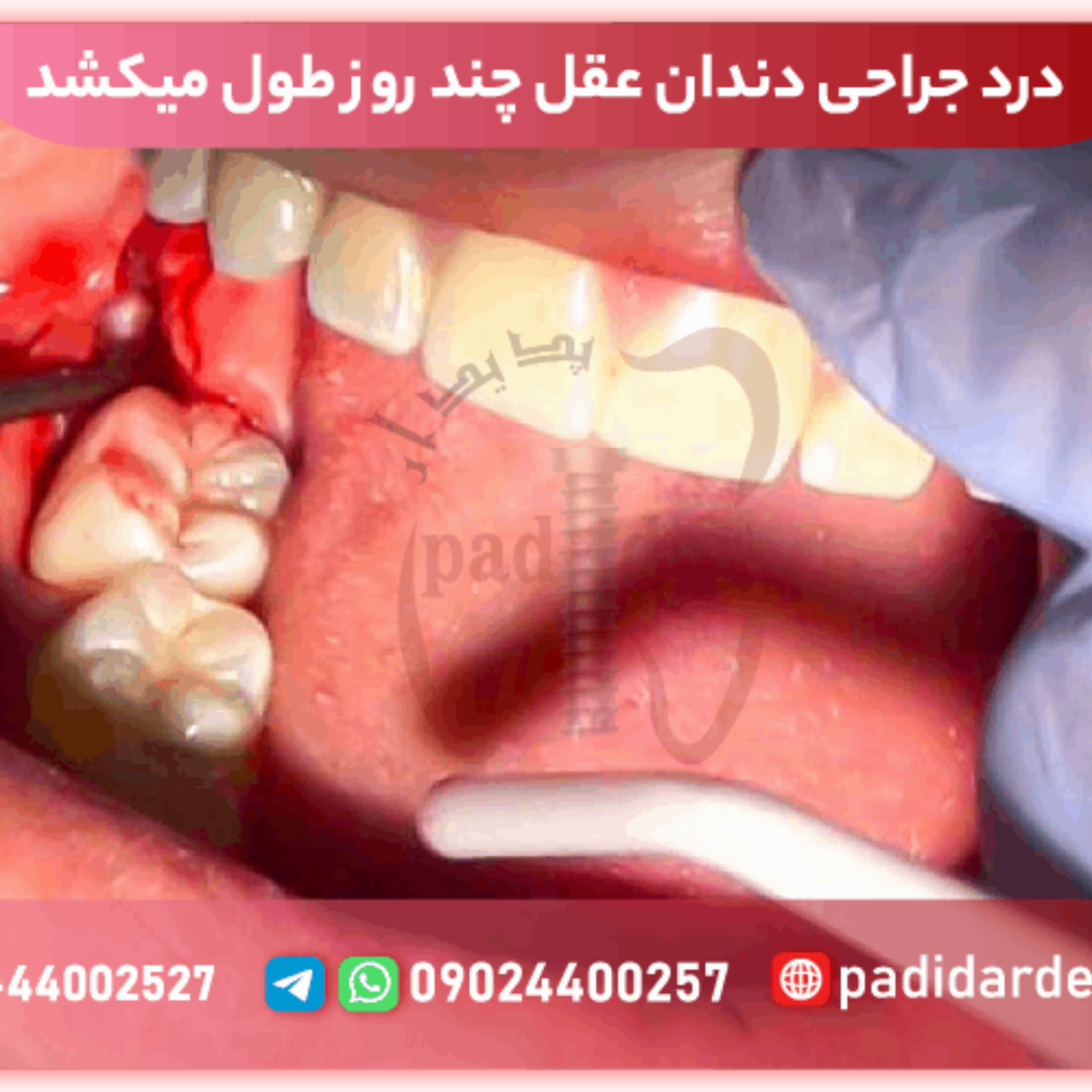 کاور درد بعد از کشیدن دندان عقل چقدر طول میکشد