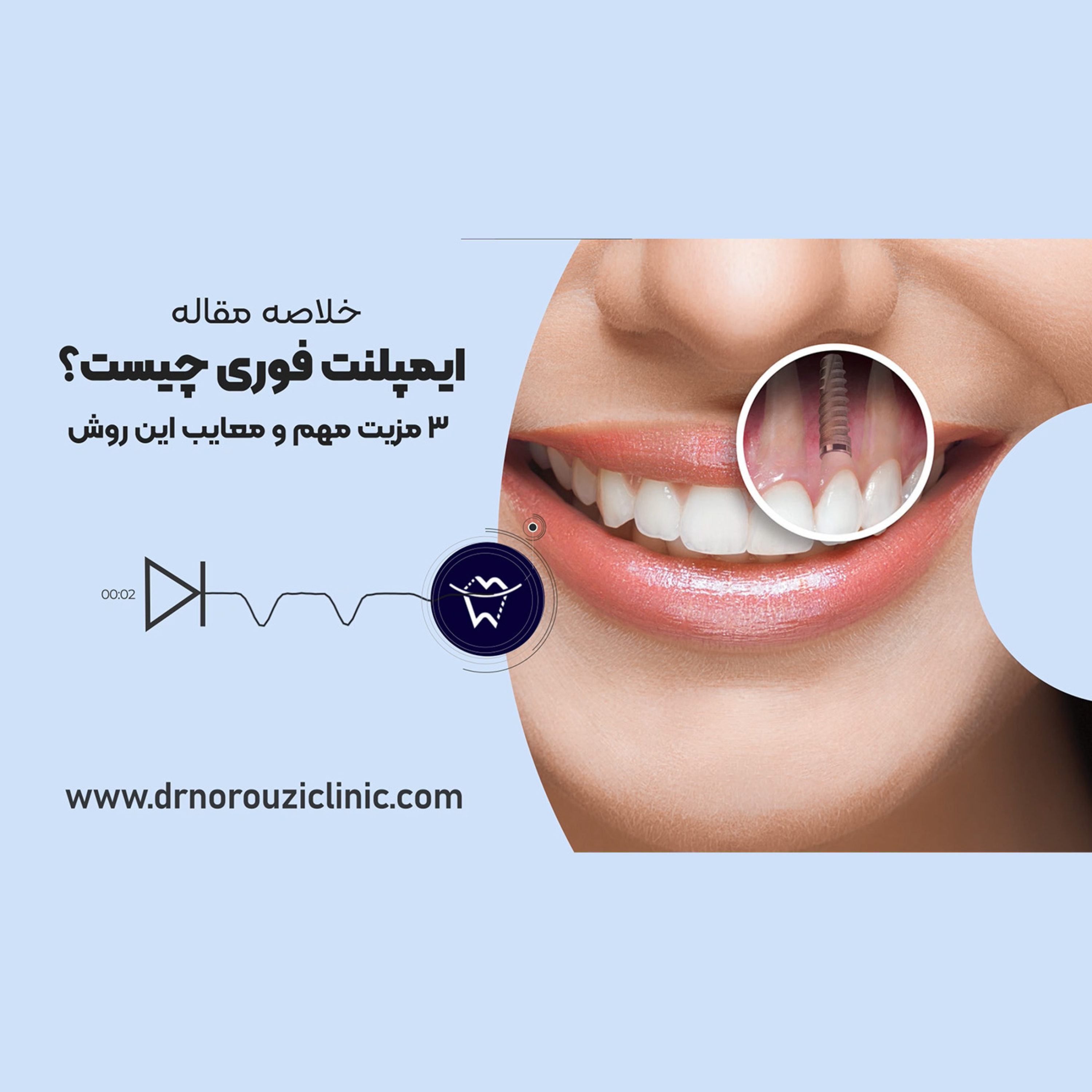 کاور ایمپلنت فوری چیست؟ ۳ مزیت مهم و معایب این روش