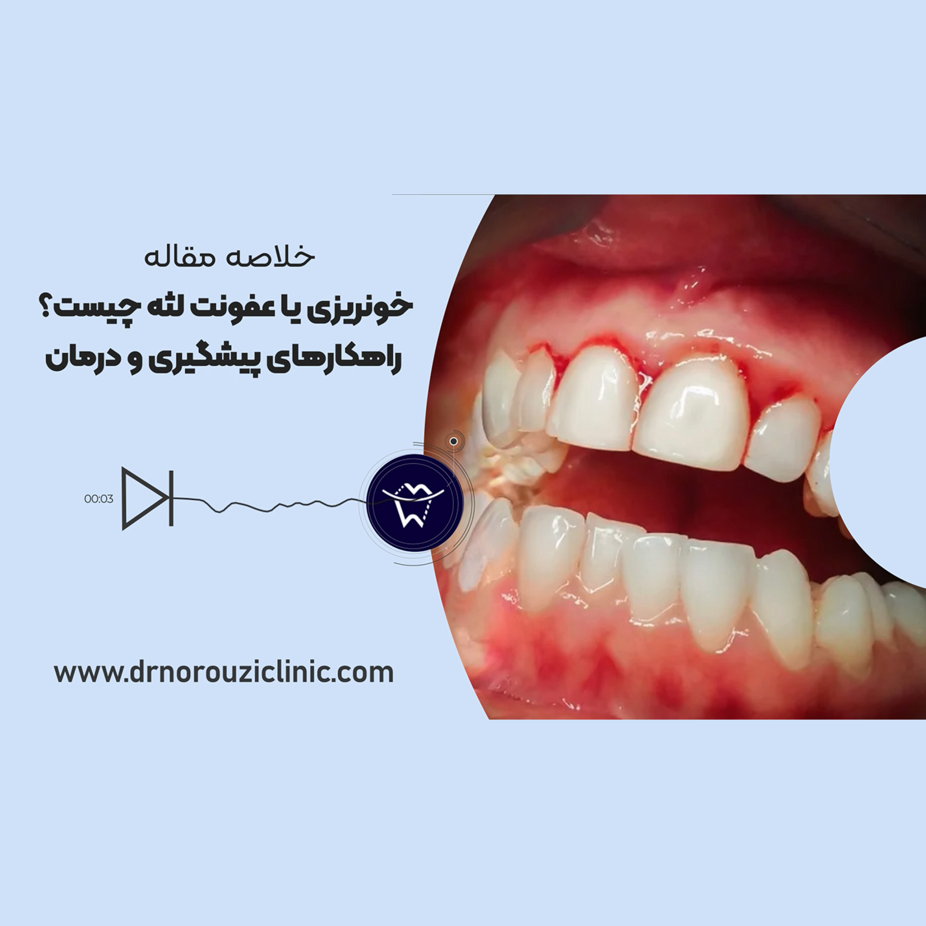کاور خونریزی یا عفونت لثه چیست؟ راهکارهای پیشگیری و درمان