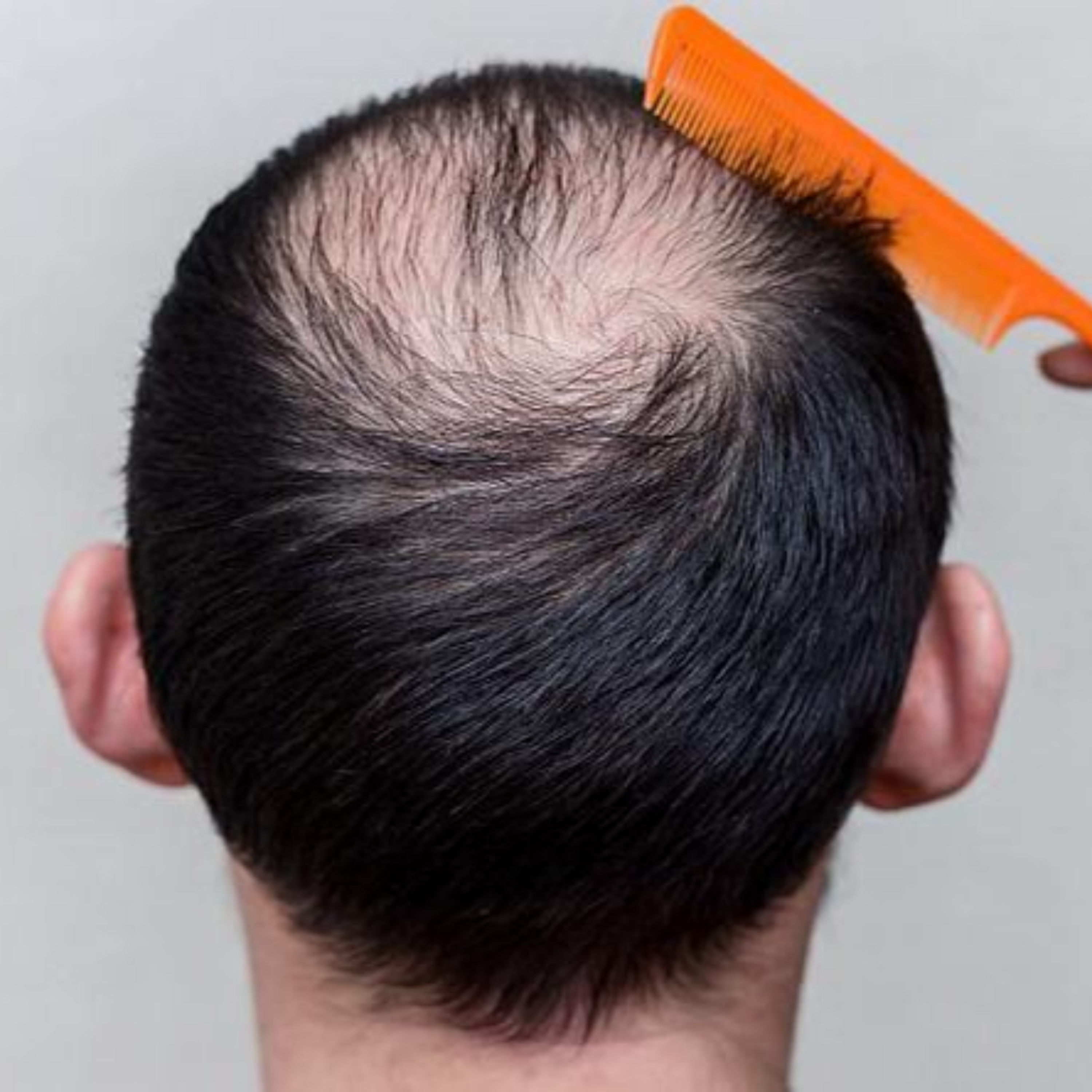 کاور پادکست علت ریزش مو پشت سر چیست؟