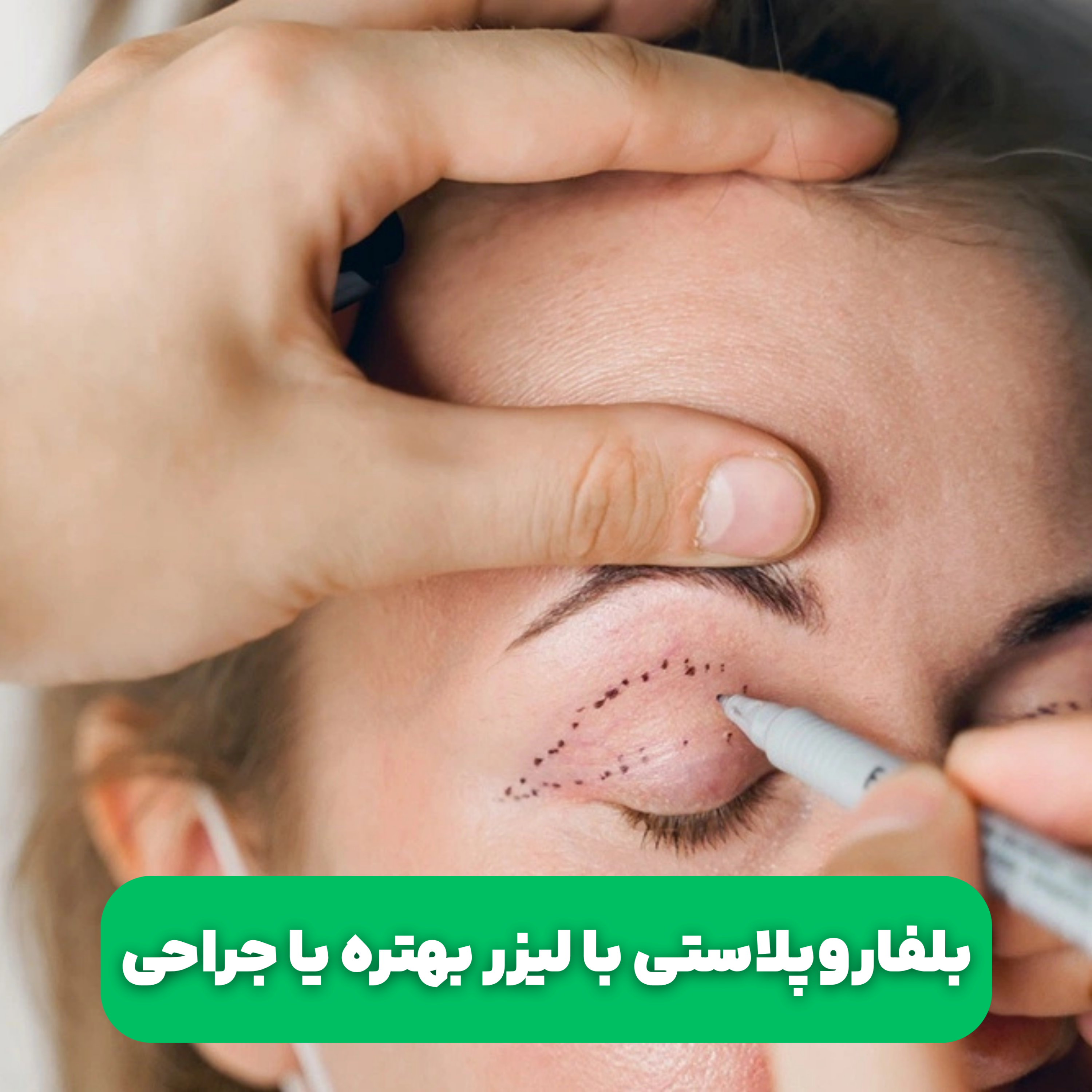 کاور بلفاروپلاستی با لیزر بهتره یا جراحی